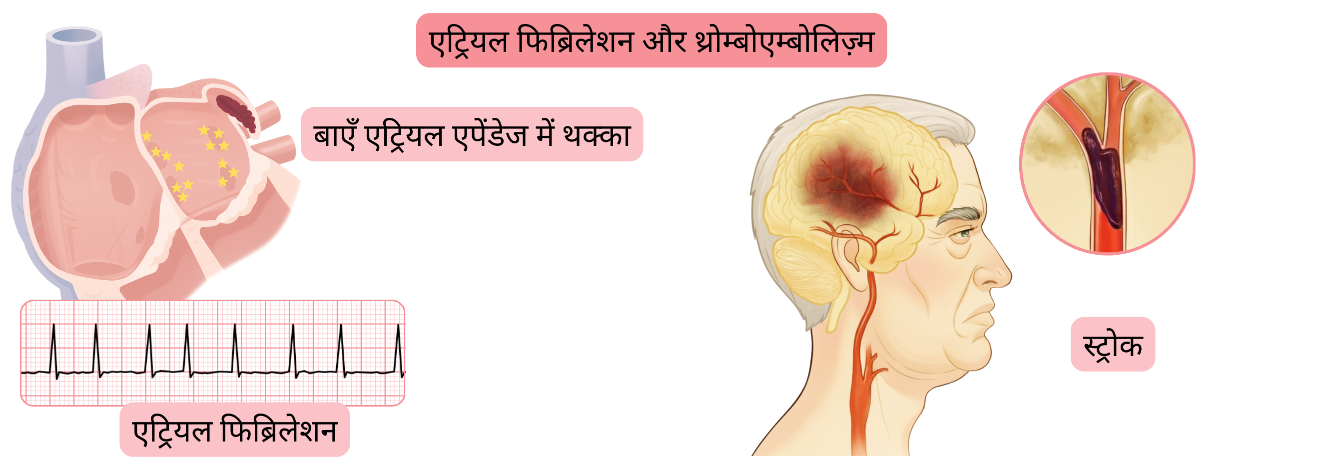 चित्रण जो एट्रियल फिब्रिलेशन में थ्रोम्बोएंबोलिज़्म को दर्शाता है, जिसमें बाएँ एट्रियल एपेंडेज में थ्रोम्बस बनना और उसके परिणामस्वरूप इस्केमिक स्ट्रोक शामिल है।