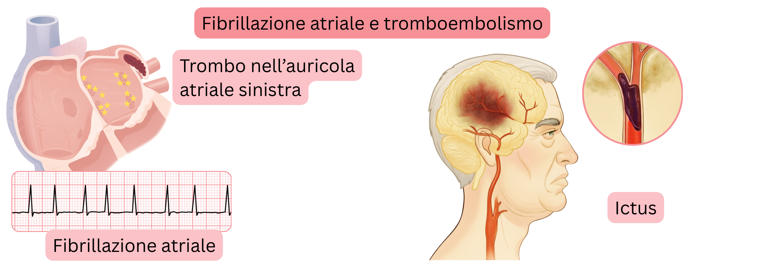 Illustrazione del tromboembolismo nella fibrillazione atriale con formazione di trombo nell’auricola sinistra e successivo ictus ischemico.