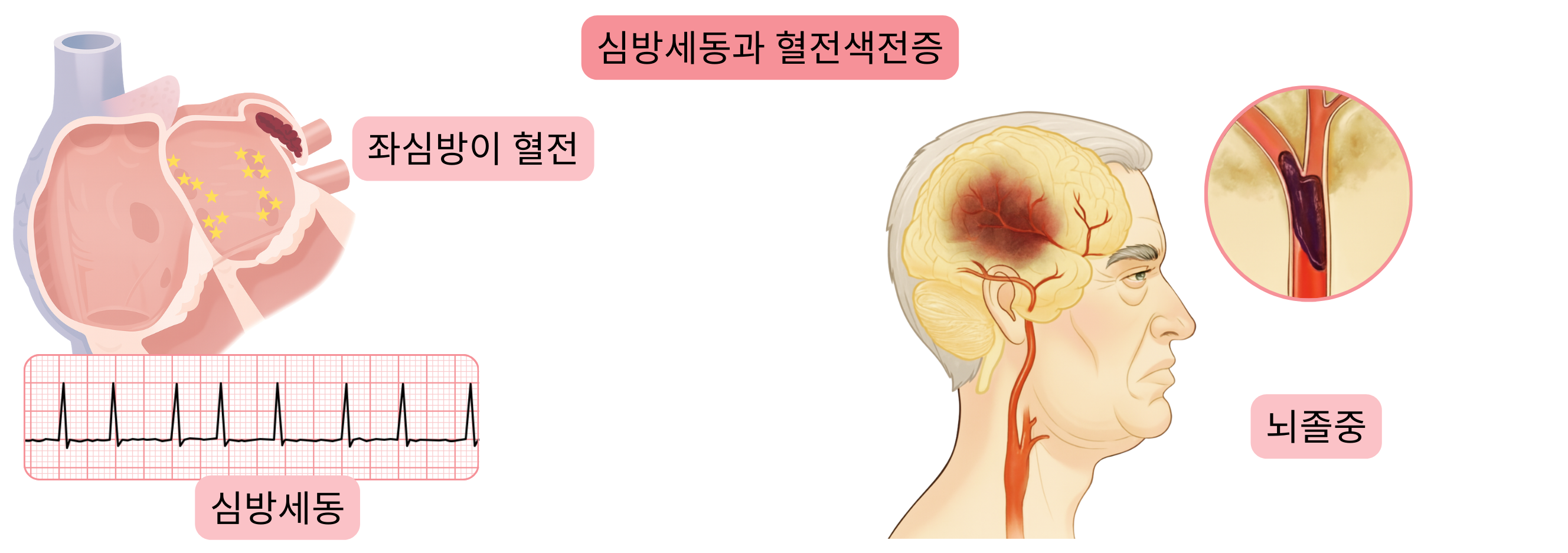 심방세동에서 좌심방이 내 혈전 형성과 이후 발생하는 허혈성 뇌졸중을 보여주는 혈전색전증 도식.