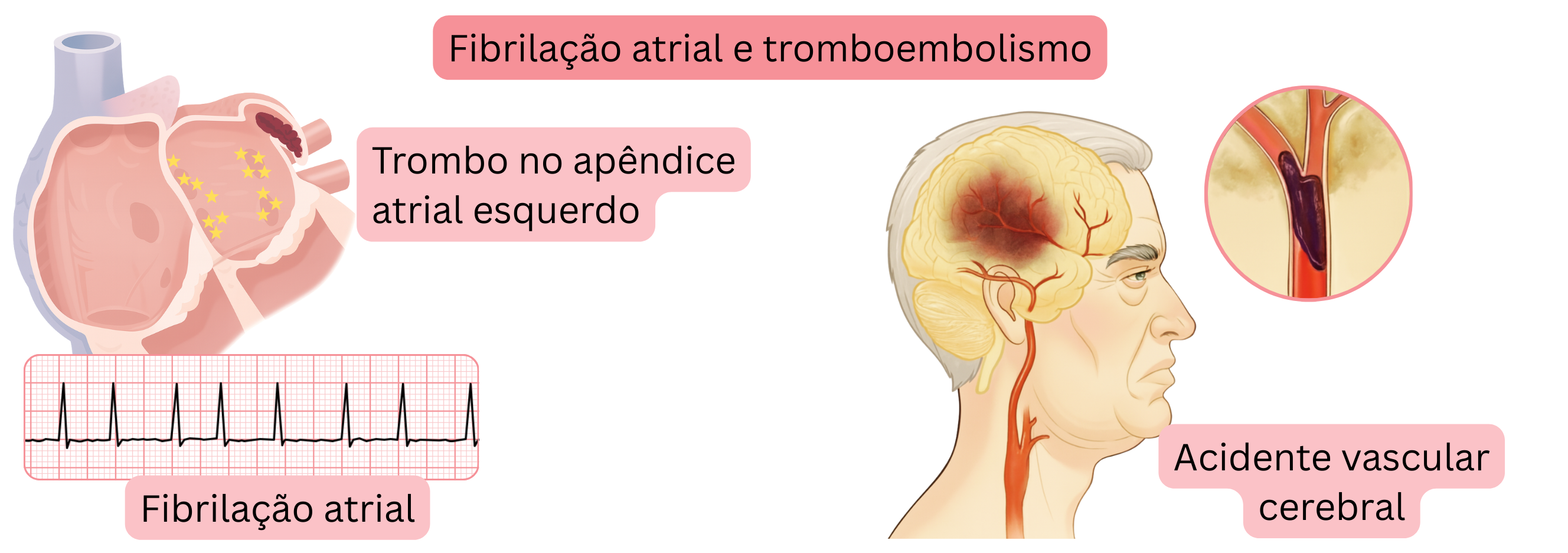 Ilustração do tromboembolismo na fibrilação atrial com formação de trombo no apêndice atrial esquerdo e subsequente acidente vascular cerebral isquémico.