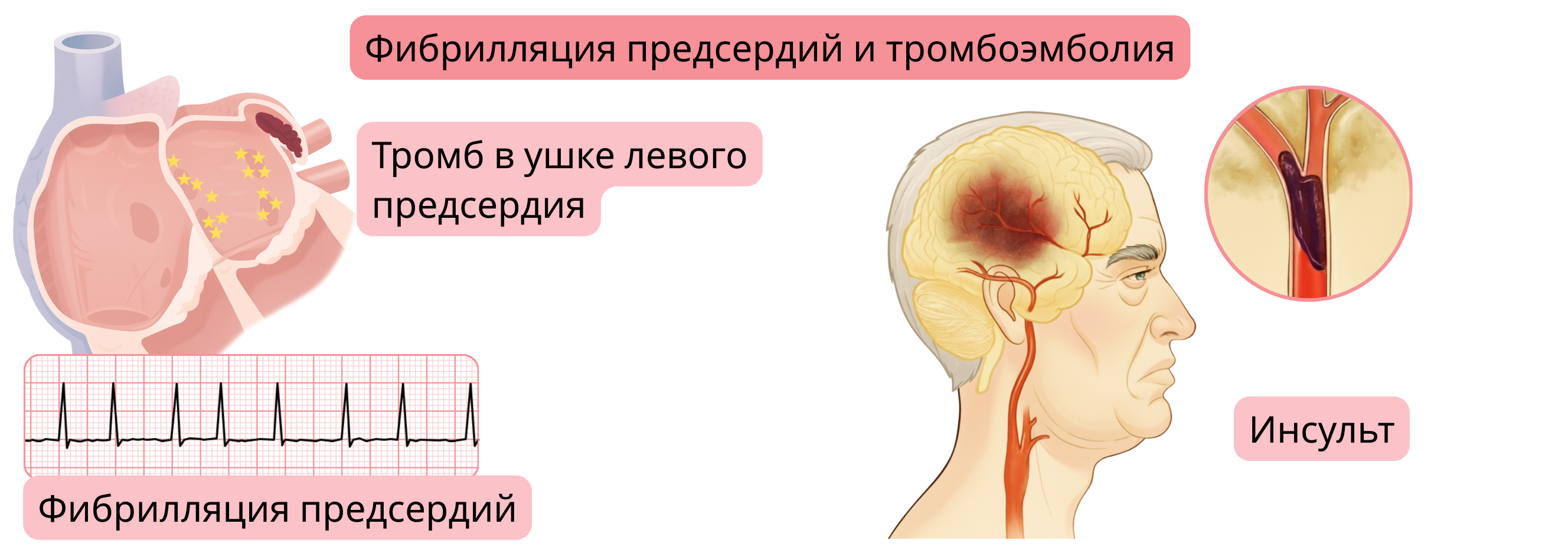 Иллюстрация тромбоэмболии при фибрилляции предсердий с образованием тромба в ушке левого предсердия и последующим ишемическим инсультом.