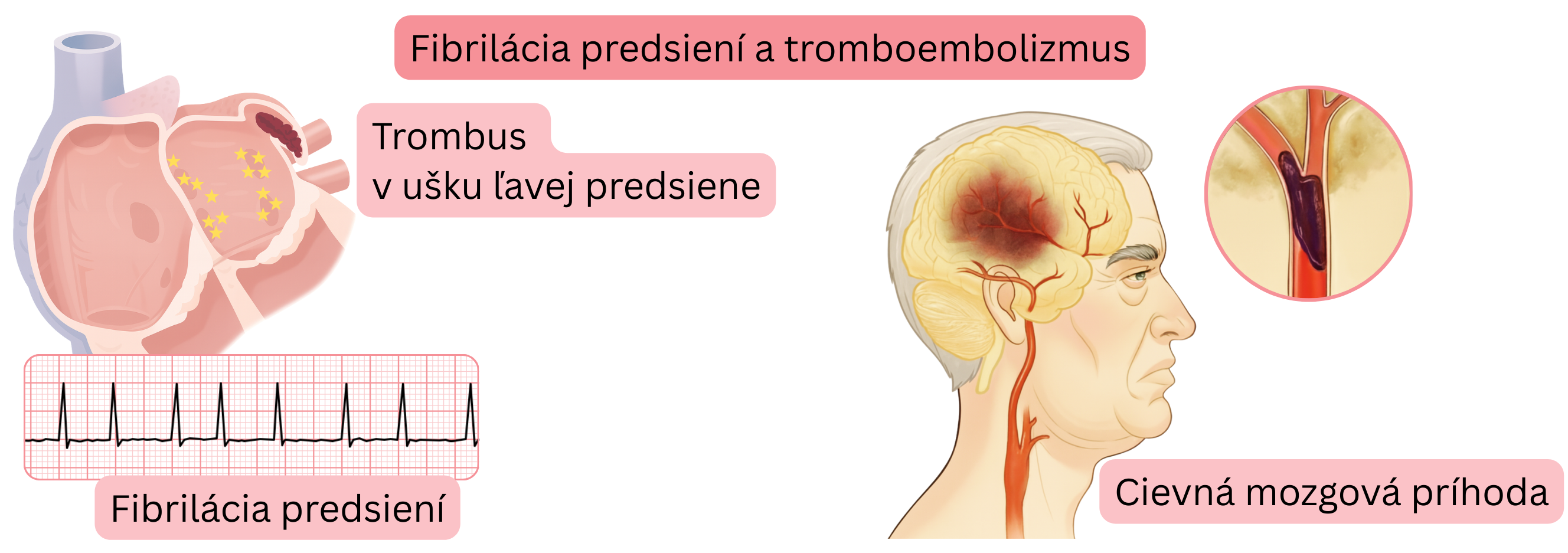 Ilustrácia tromboembolizmu pri fibrilácii predsiení s tvorbou trombu v ušku ľavej predsiene a následnou cievnou mozgovou príhodou.