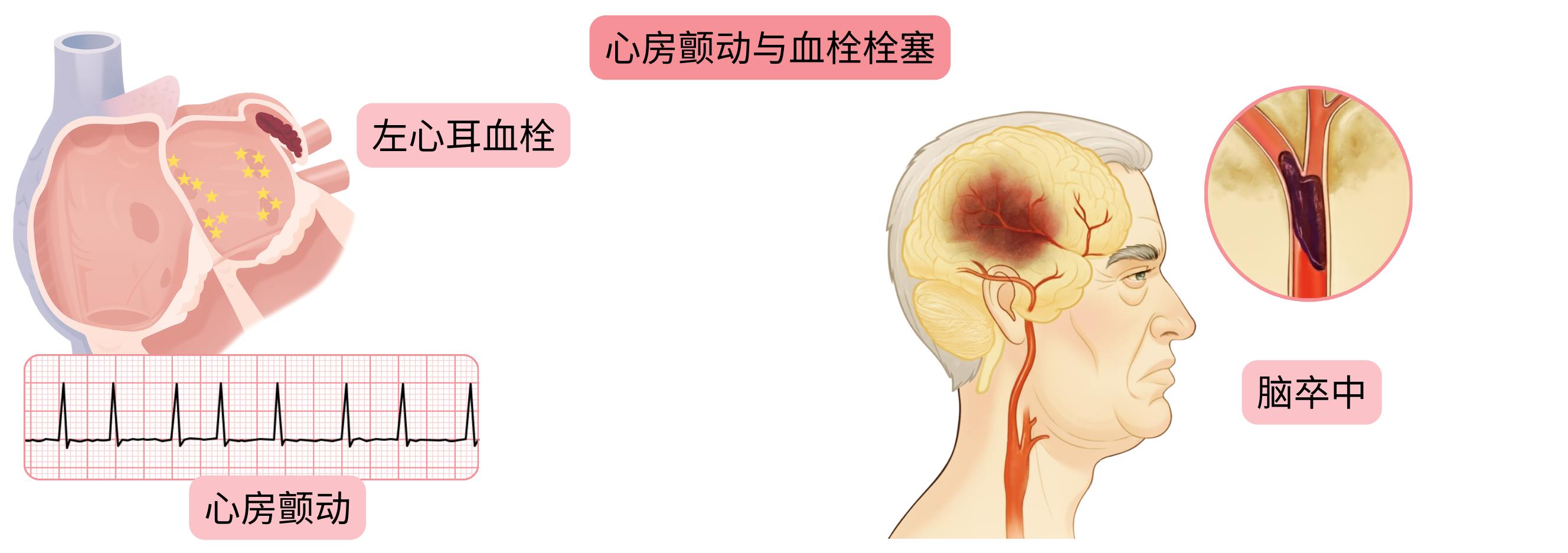 示意图展示心房颤动相关的血栓栓塞机制，包括左心耳血栓形成并导致缺血性脑卒中。