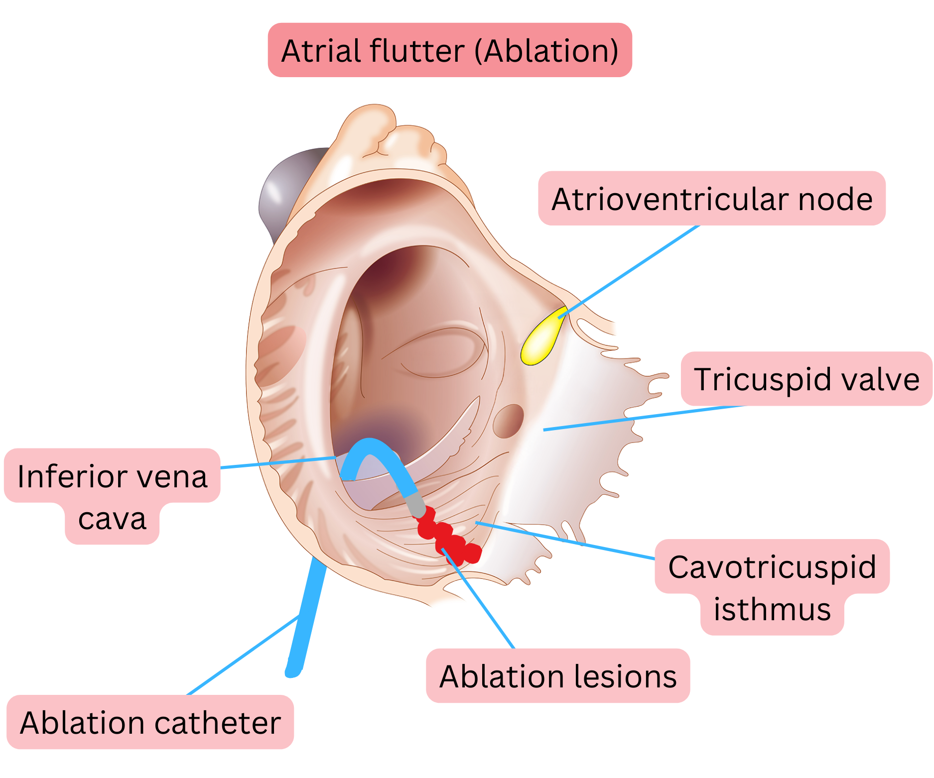 Diagram of catheter ablation for typical atrial flutter showing creation of an ablation line across the cavotricuspid isthmus.