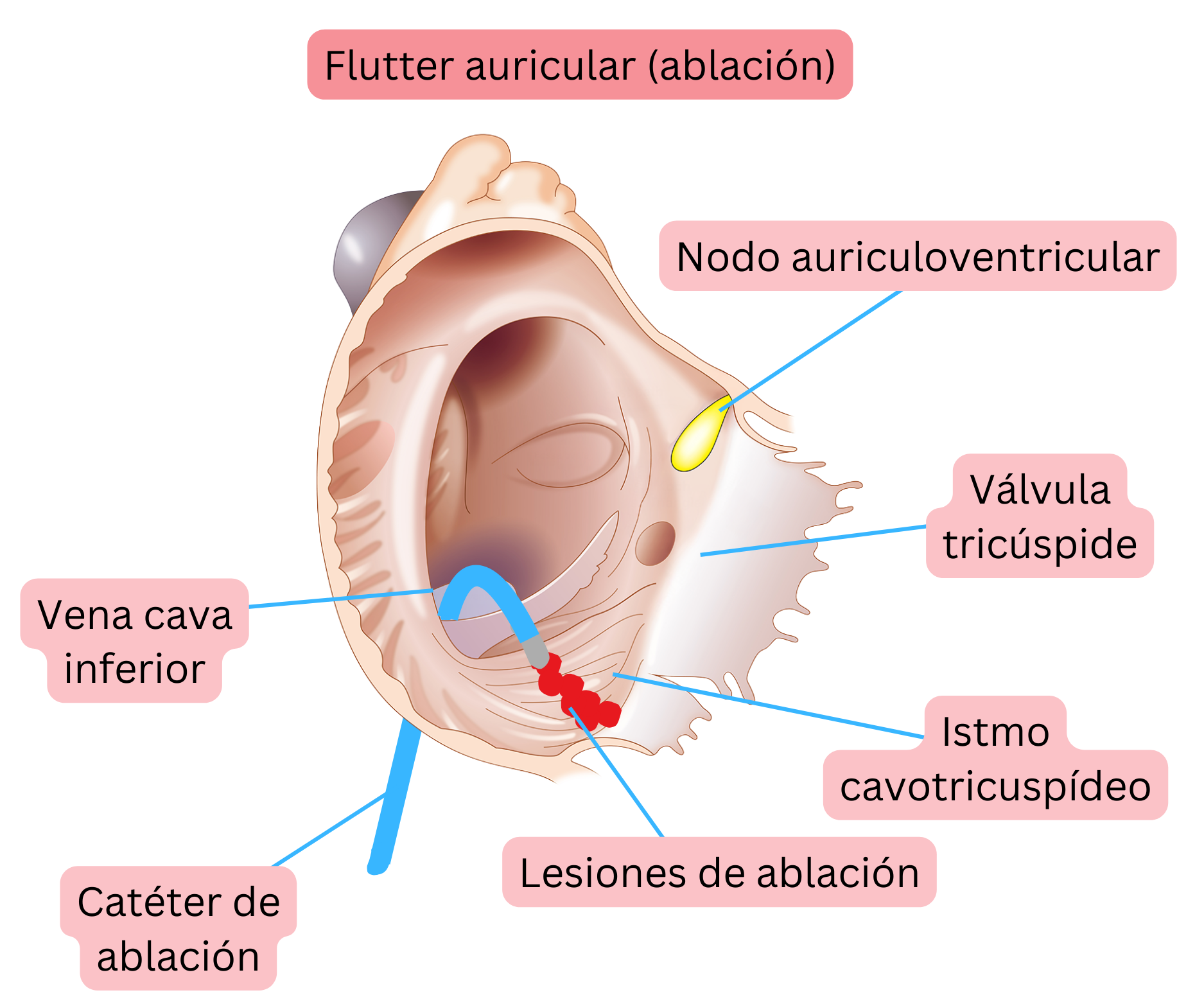 Esquema de la ablación con catéter del flutter auricular típico que muestra la creación de una línea de ablación en el istmo cavotricuspídeo.