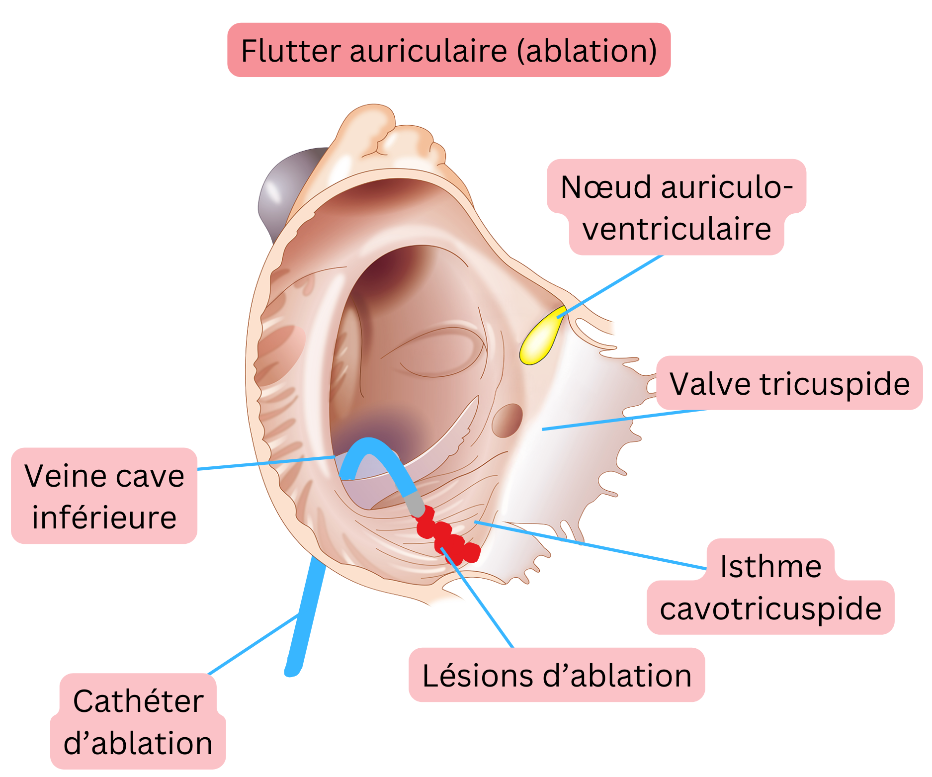 Schéma de l’ablation par cathéter du flutter auriculaire typique montrant la création d’une ligne d’ablation au niveau de l’isthme cavotricuspide.