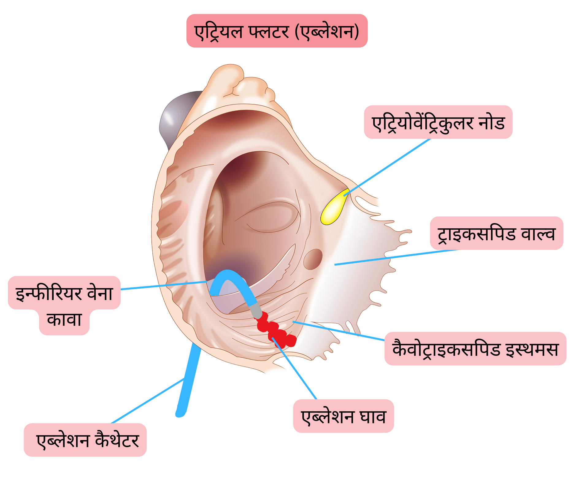 टिपिकल एट्रियल फ्लटर की कैथेटर एब्लेशन का आरेख, जिसमें कैवोट्राइकसपिड इस्थमस पर एब्लेशन लाइन बनाई गई है।
