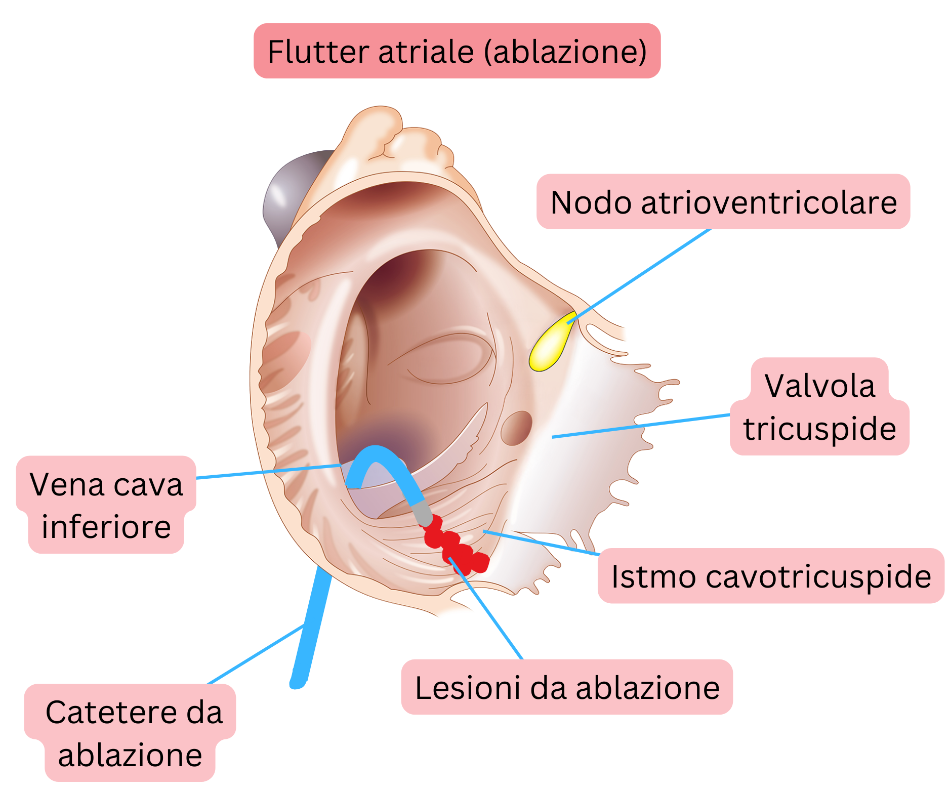 Schema dell’ablazione transcatetere del flutter atriale tipico con creazione di una linea di ablazione nell’istmo cavotricuspide.