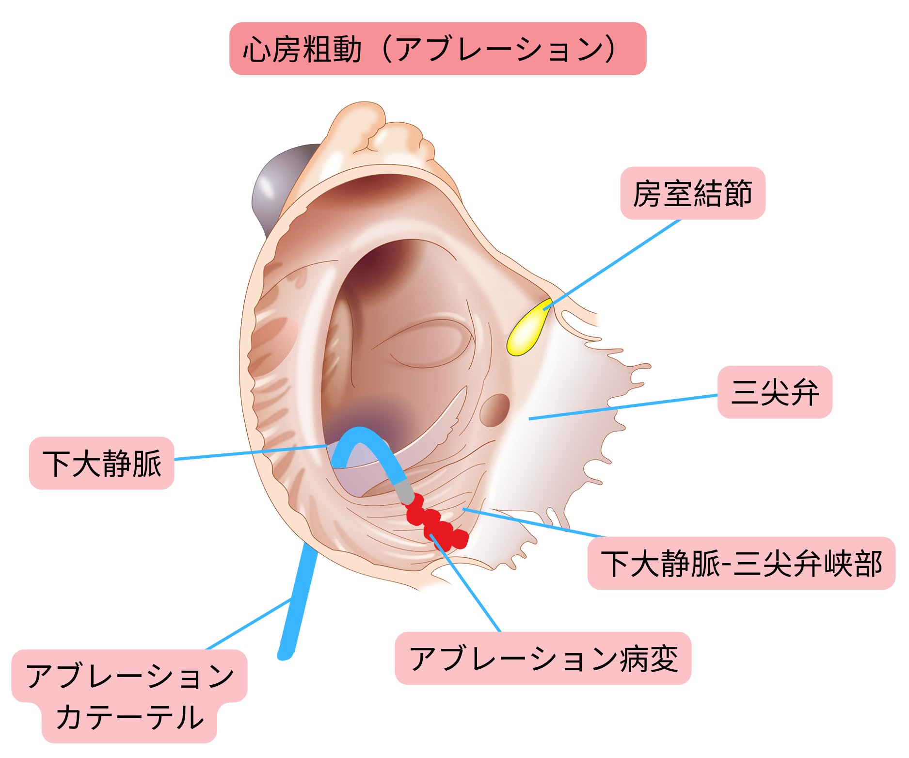 典型的心房粗動に対するカテーテルアブレーションの模式図で、下大静脈―三尖弁間峡部にアブレーションラインを作成する。
