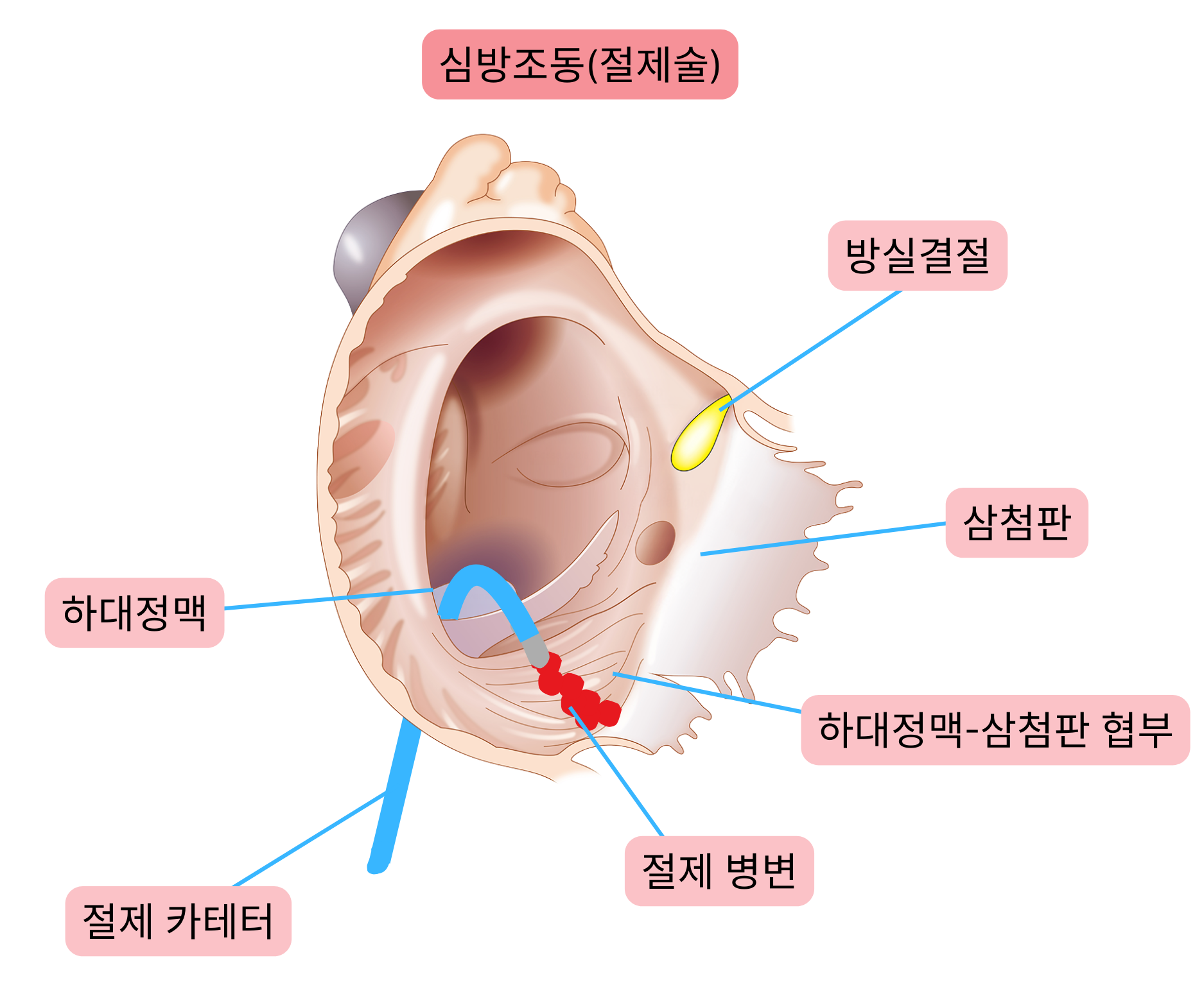 전형적 심방조동에 대한 카테터 절제술 도식으로, 하대정맥–삼첨판 사이의 협부에 절제선을 형성함을 보여준다.