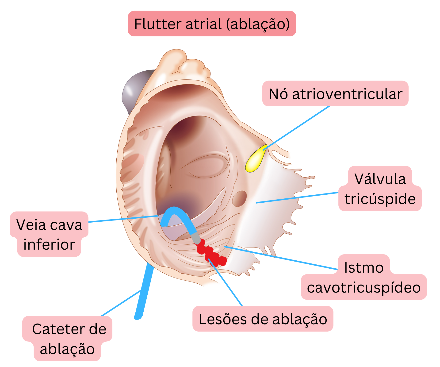 Esquema da ablação por cateter do flutter atrial típico mostrando a criação de uma linha de ablação no istmo cavotricúspide.