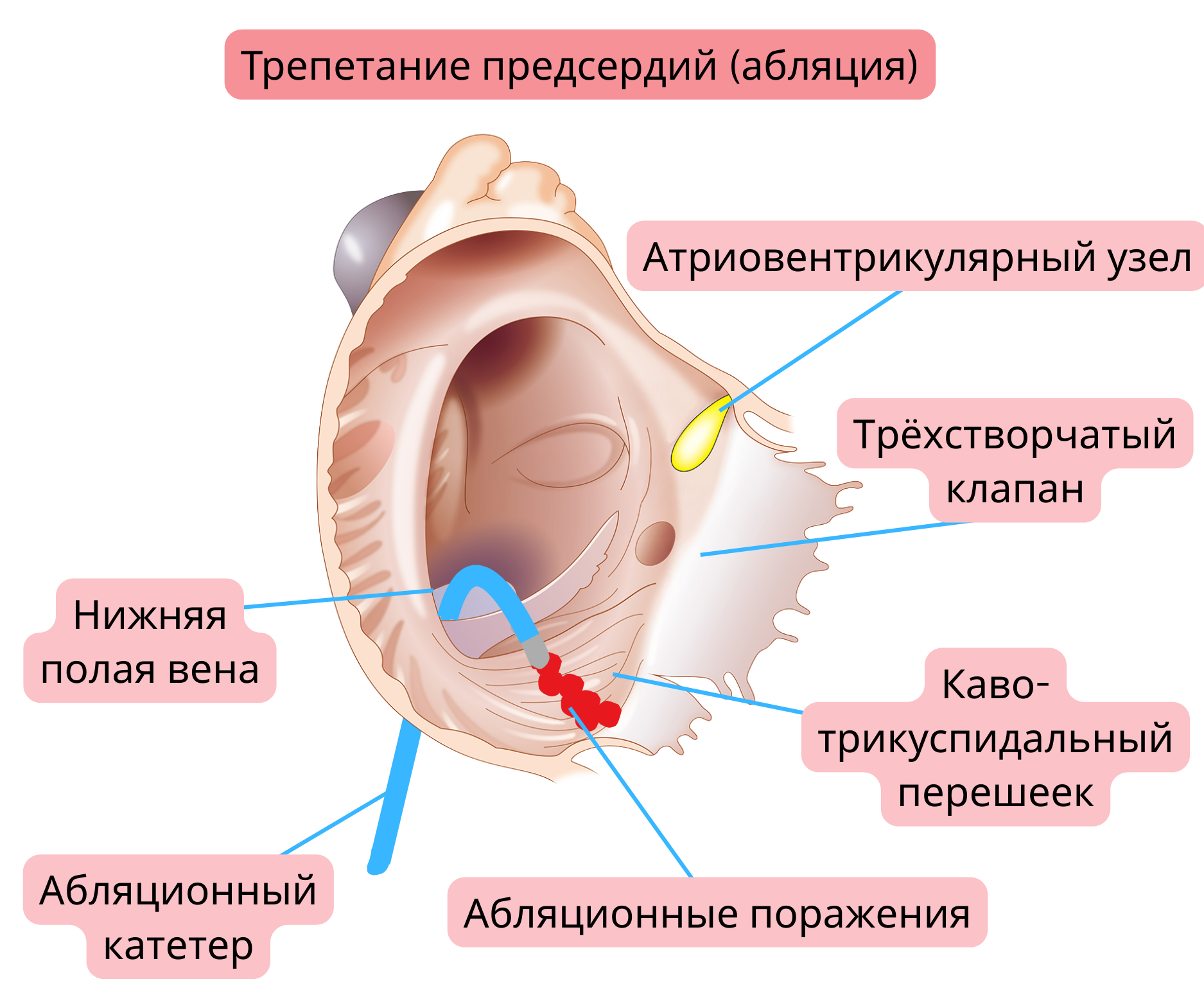 Схема катетерной аблации типичного трепетания предсердий с формированием аблационной линии в кавотрикуспидальном перешейке.