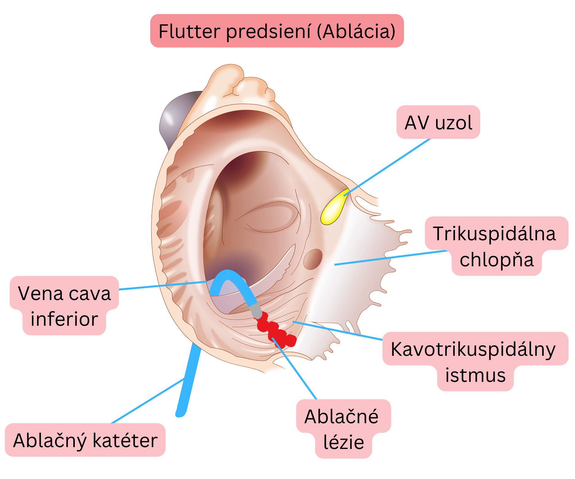 Schéma katétrovej ablácie typického predsieňového flutteru s vytvorením ablačnej línie v kavotrikuspidálnom istme.