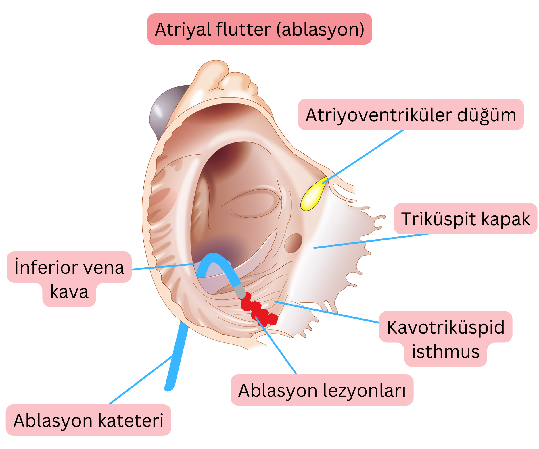 Tipik atriyal flutter için kateter ablasyonunu ve kavotriküspit isthmusta ablasyon hattının oluşturulmasını gösteren şema.