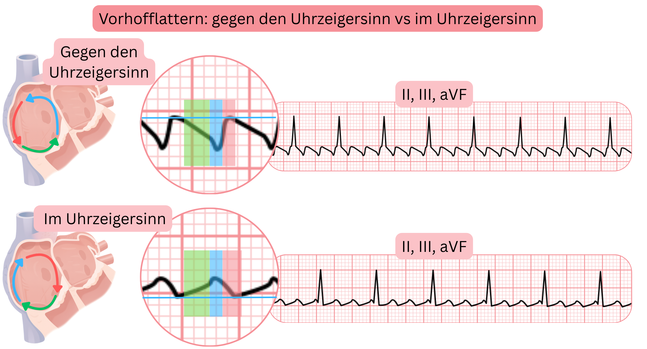 Vergleich des typischen Vorhofflatterns mit gegenläufigen und im Uhrzeigersinn verlaufenden Reentry-Kreisläufen sowie unterschiedlicher Morphologie der Flatterwellen in den EKG-Ableitungen II, III und aVF.
