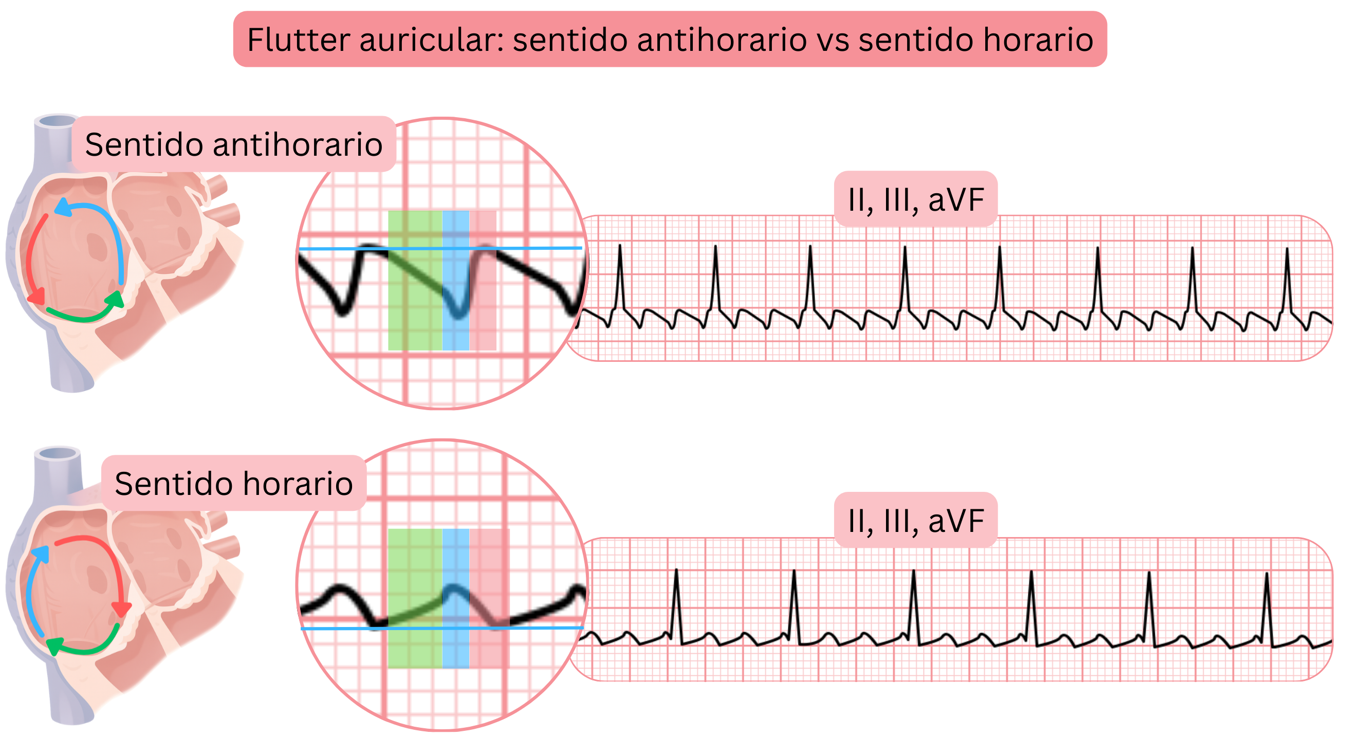 Comparación del flutter auricular típico con circuitos de reentrada antihorario y horario y con diferencias en la morfología de las ondas de flutter en las derivaciones II, III y aVF del ECG.