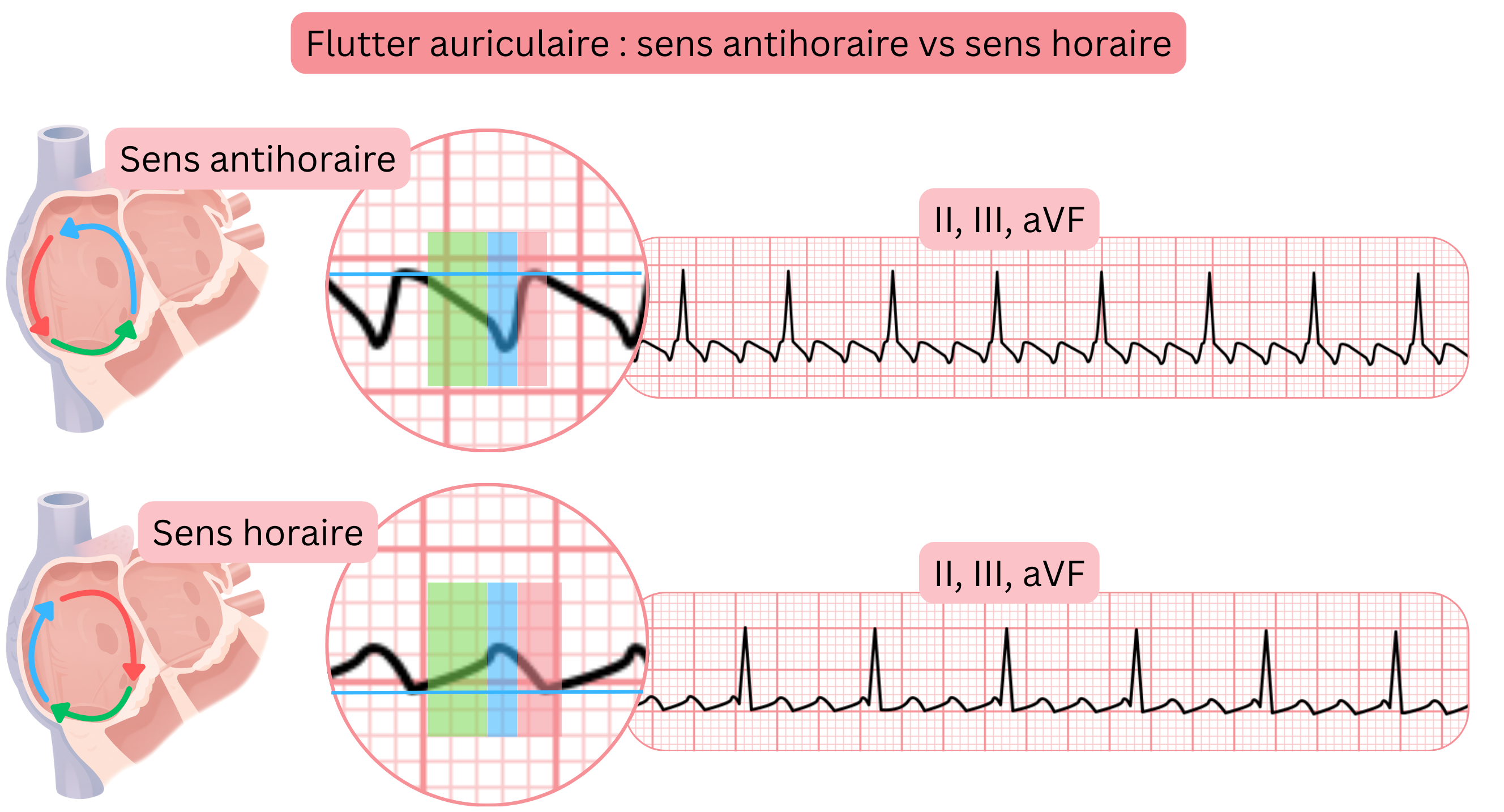 Comparaison du flutter auriculaire typique avec des circuits de réentrée antihoraire et horaire et des différences de morphologie des ondes de flutter dans les dérivations ECG II, III et aVF.