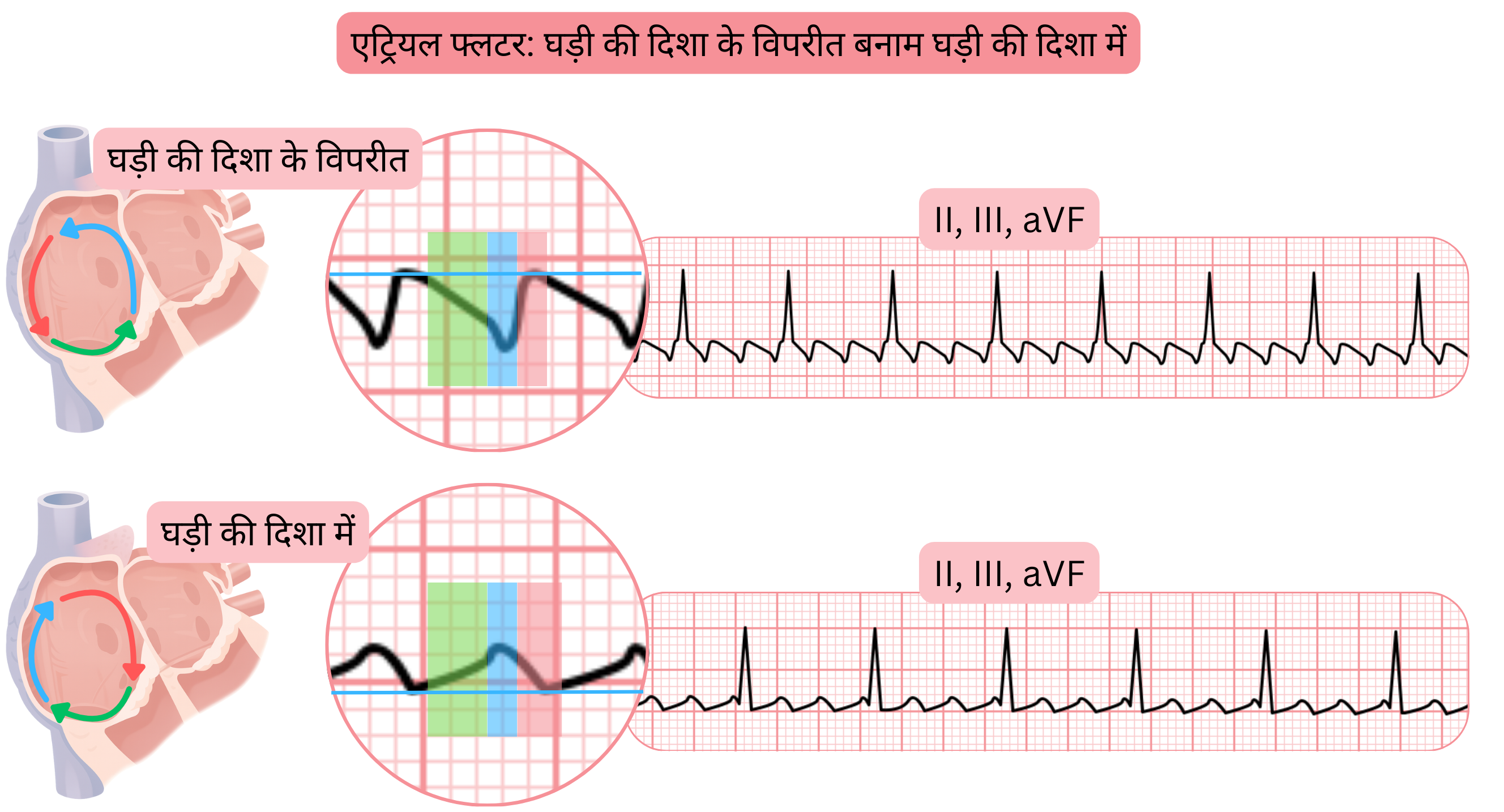 टिपिकल एट्रियल फ्लटर की तुलना, जिसमें काउंटर-क्लॉकवाइज़ और क्लॉकवाइज़ रिएन्ट्री सर्किट तथा ईसीजी के II, III और aVF लीड्स में फ्लटर वेव की भिन्न आकृति दिखाई गई है।