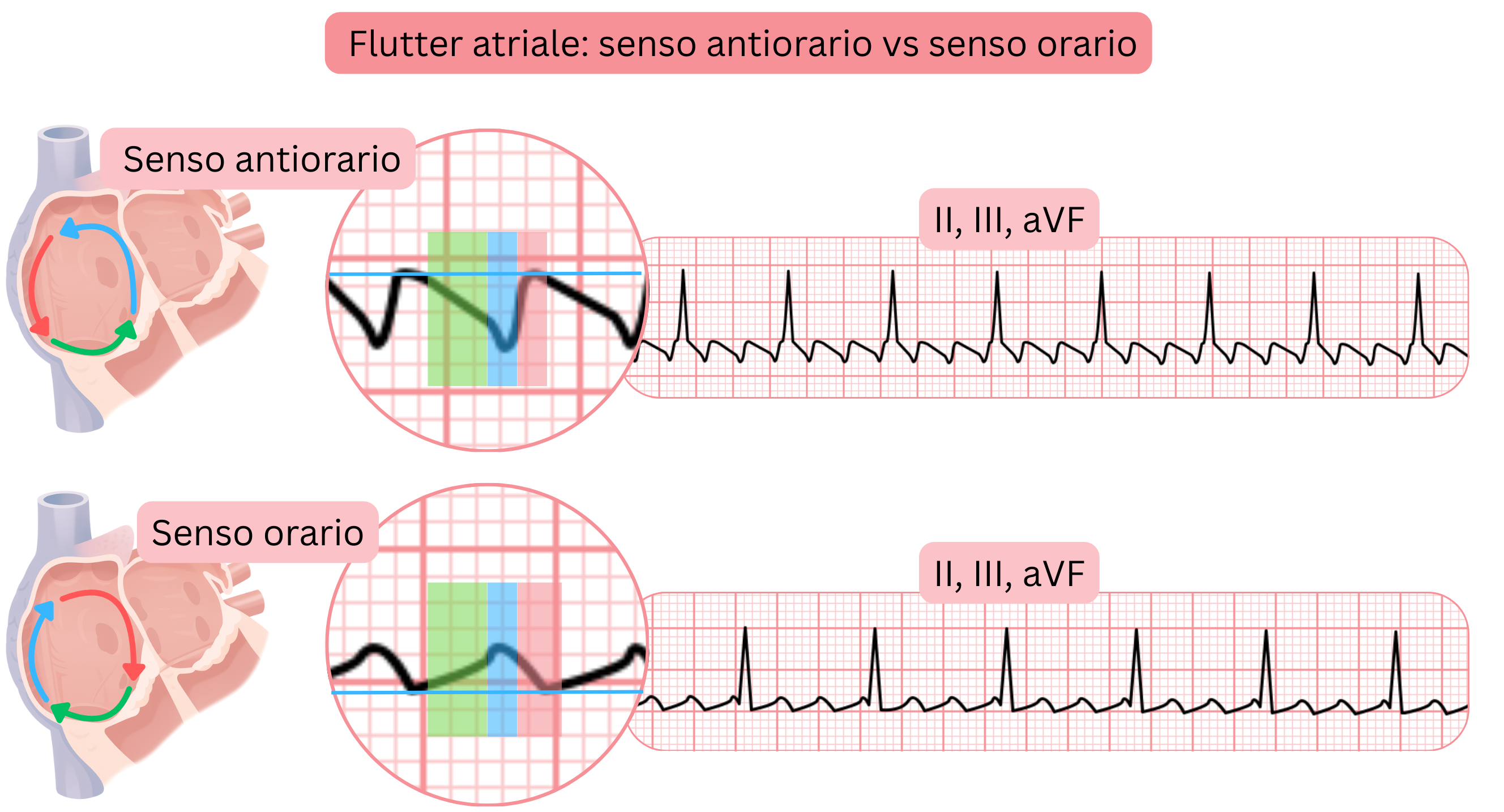Confronto del flutter atriale tipico con circuiti di rientro in senso antiorario e orario e con differenze nella morfologia delle onde di flutter nelle derivazioni ECG II, III e aVF.