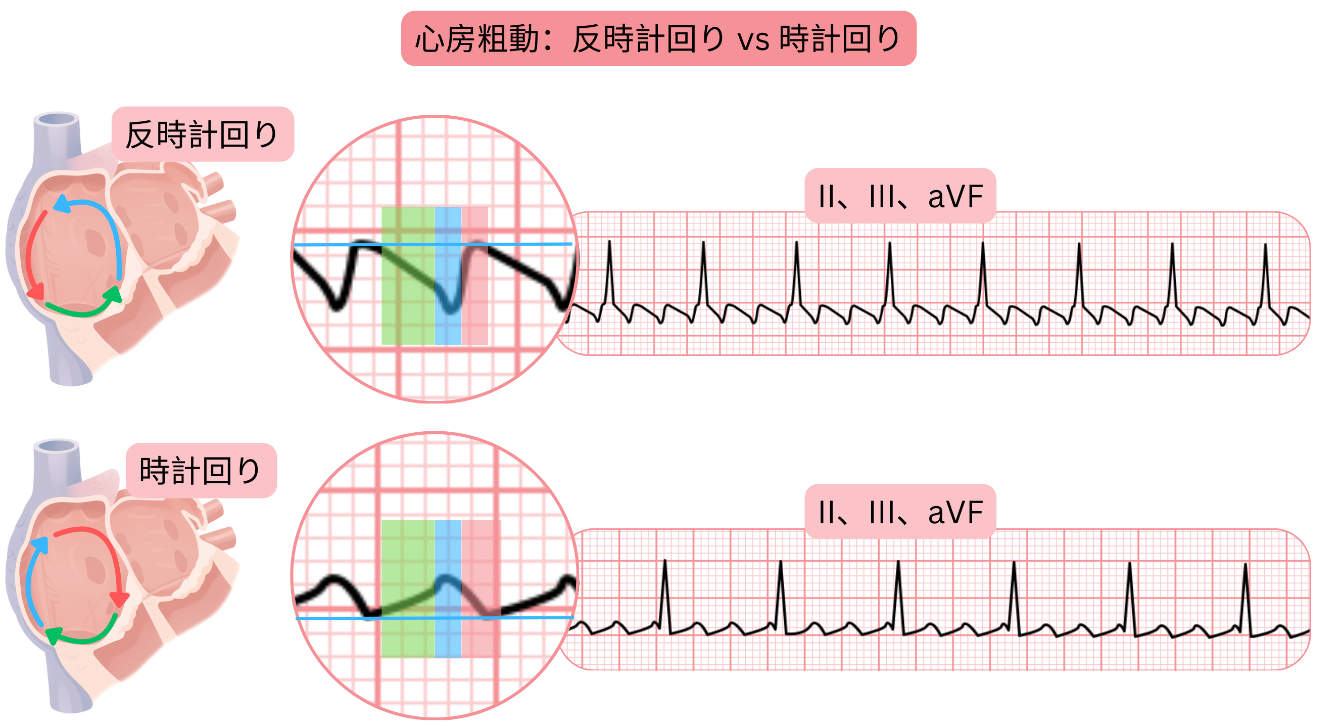 反時計回りおよび時計回りのリエントリー回路を有する典型的心房粗動の比較と、心電図II、III、aVF誘導における粗動波形態の違いを示す。