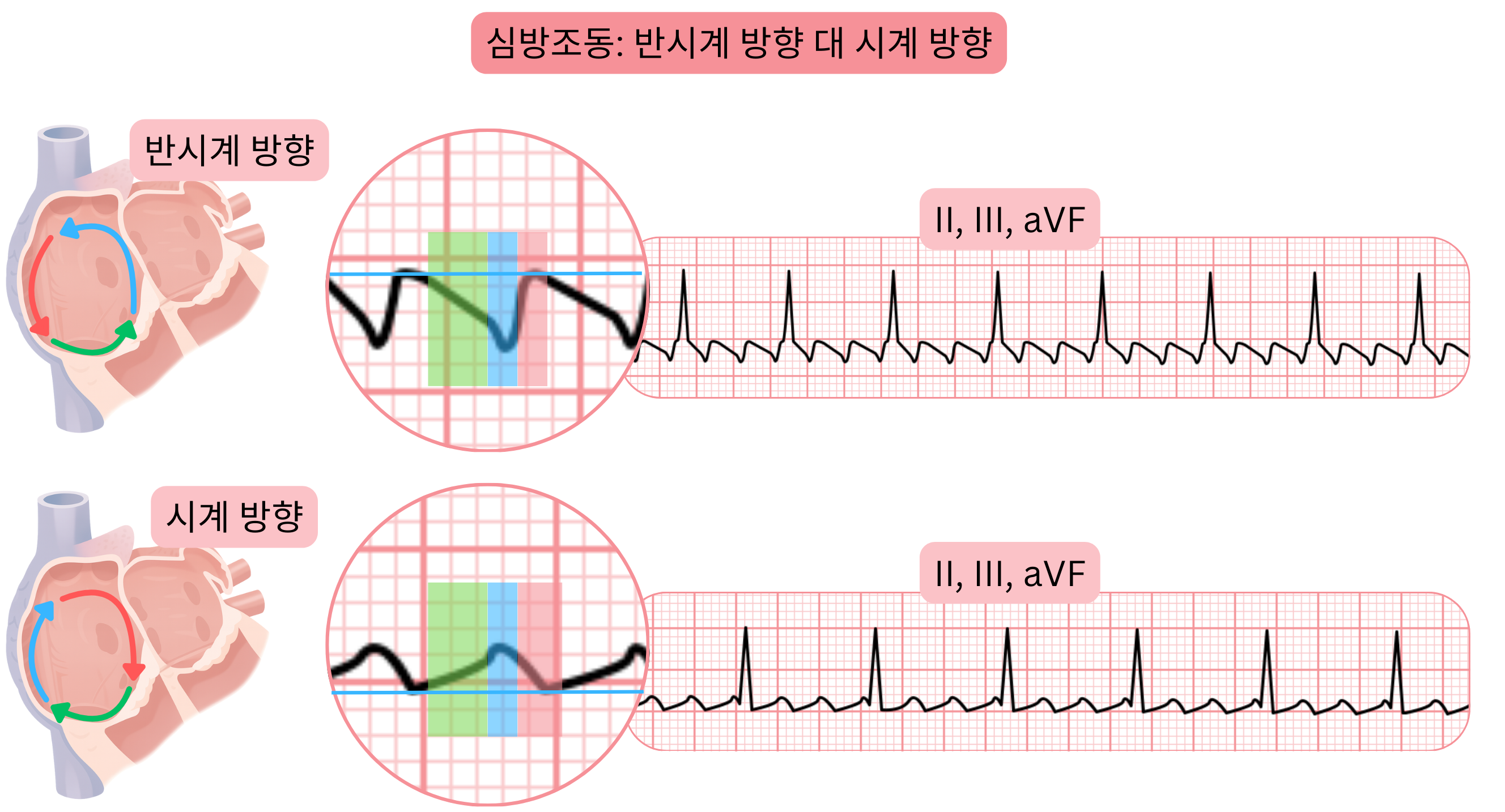 반시계 방향과 시계 방향 재진입 회로를 보이는 전형적 심방조동의 비교와 심전도 II, III, aVF 유도에서의 조동파 형태 차이를 나타낸다.