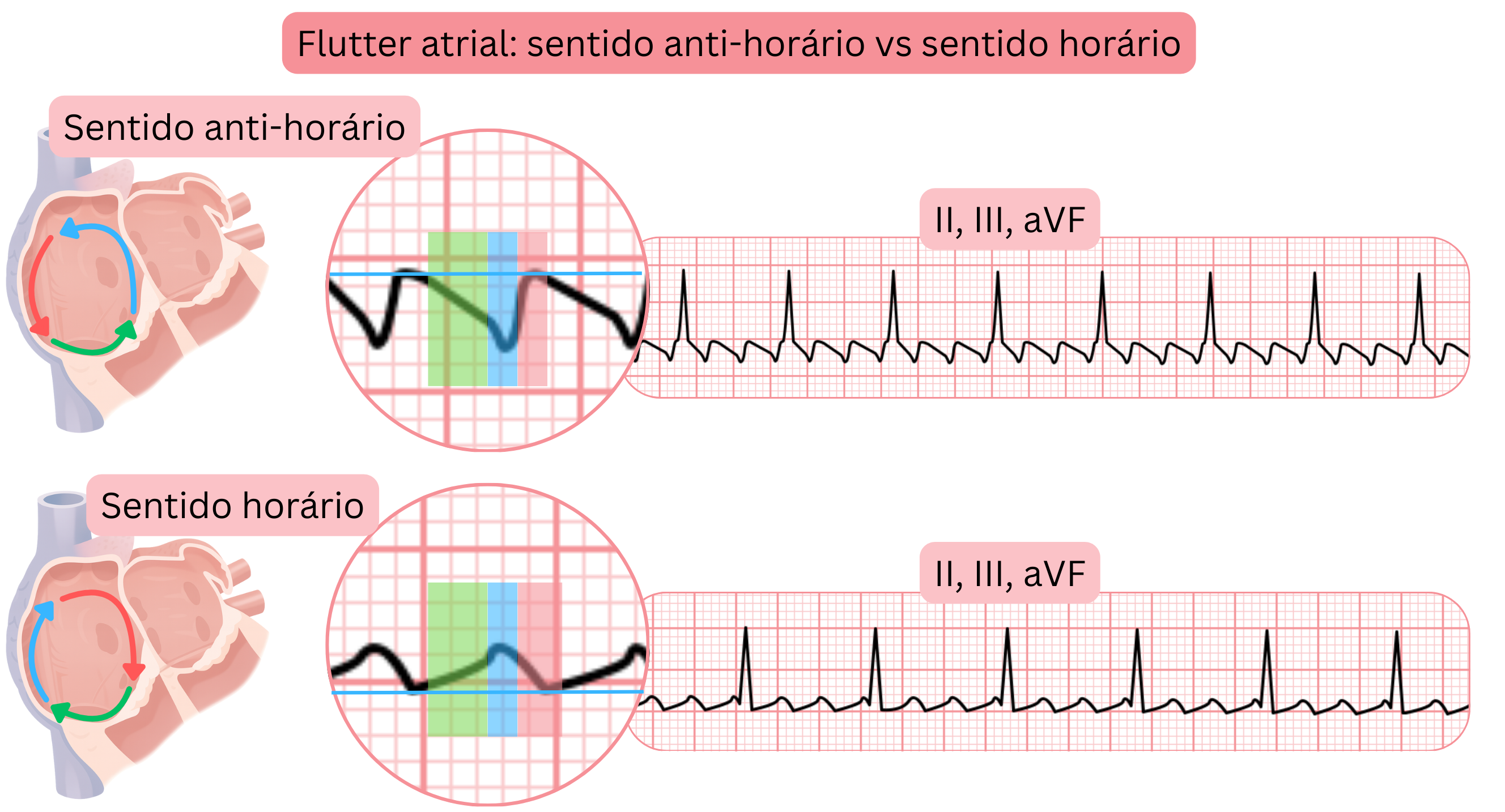 Comparação do flutter atrial típico com circuitos de reentrada no sentido anti-horário e horário e com diferenças na morfologia das ondas de flutter nas derivações II, III e aVF do ECG.