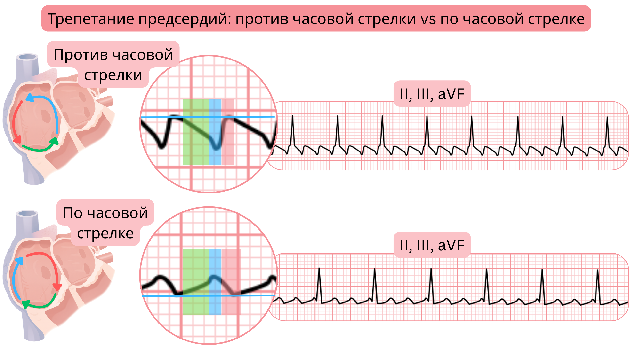 Сравнение типичного трепетания предсердий с реэнтри-контурами против и по часовой стрелке и различной морфологией волн трепетания в отведениях ЭКГ II, III и aVF.