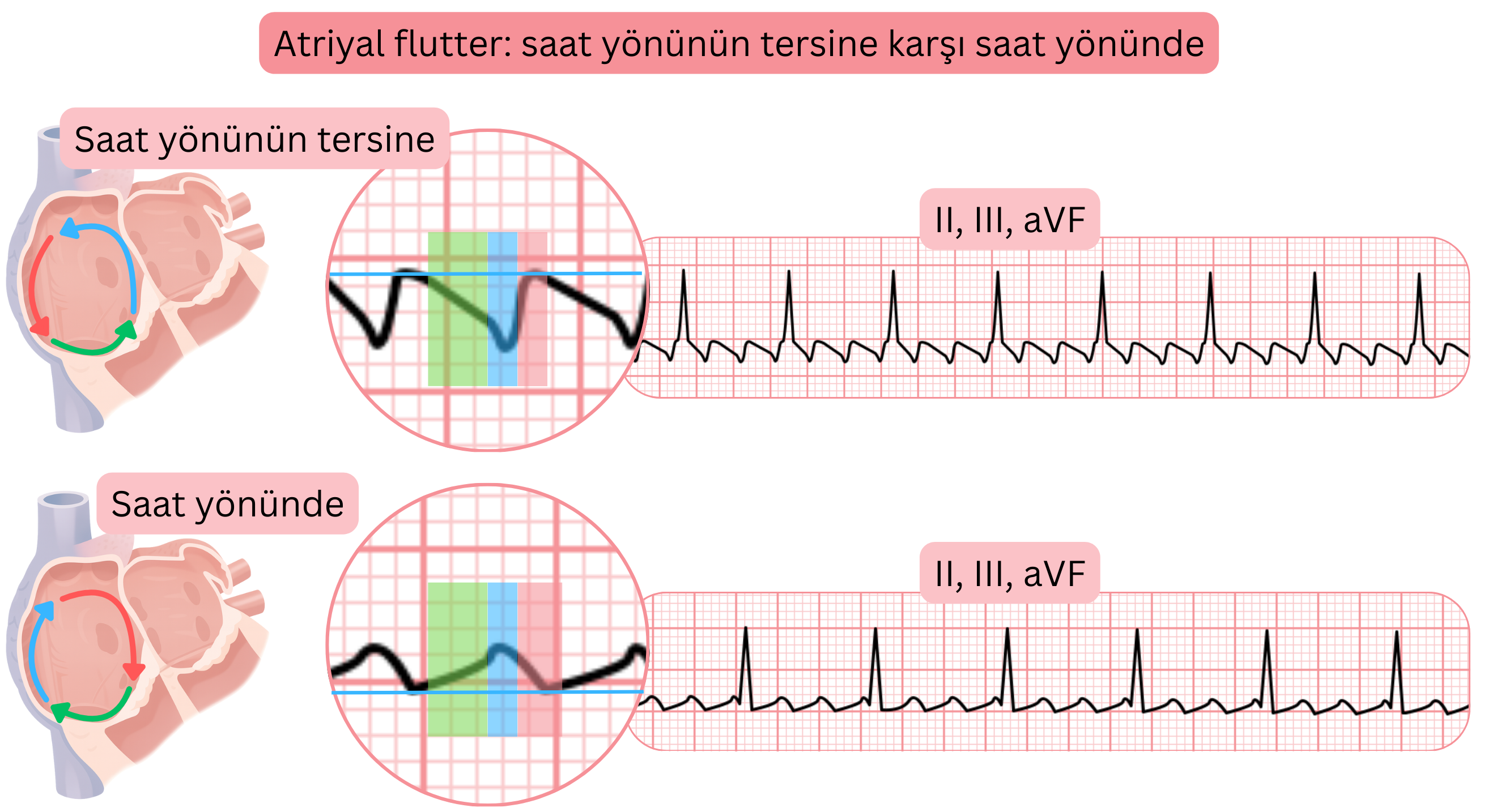 Saat yönünün tersine ve saat yönünde reentry devreleri olan tipik atriyal flutterin karşılaştırılması ve EKG’de II, III ve aVF derivasyonlarında flutter dalga morfolojisindeki farklılıklar.