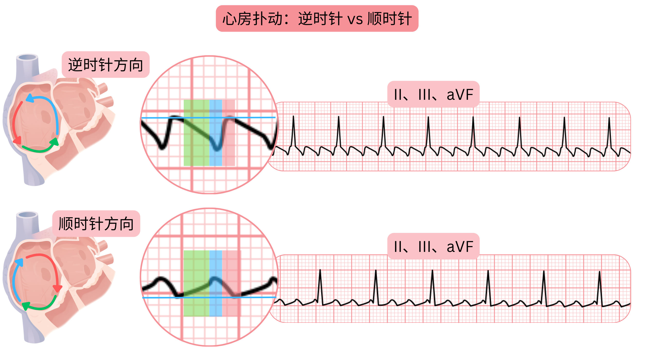 对比典型心房扑动的逆时针与顺时针折返环路，以及心电图II、III和aVF导联中扑动波形态的差异。