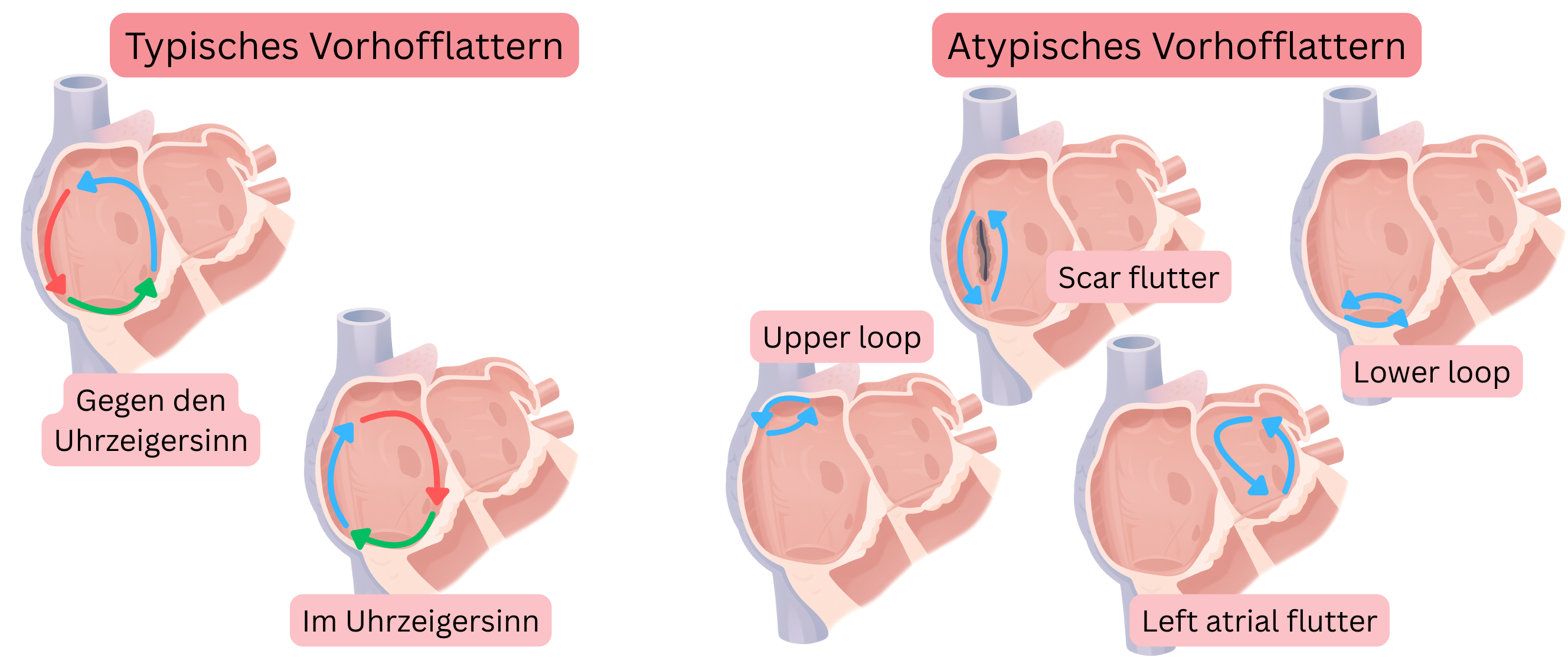 Schema zum Vergleich des typischen Vorhofflatterns mit Reentry-Kreisläufen im und gegen den Uhrzeigersinn und des atypischen Vorhofflatterns einschließlich narbenassoziiertem, Upper-Loop-, Lower-Loop- und linksatrialem Flutter.