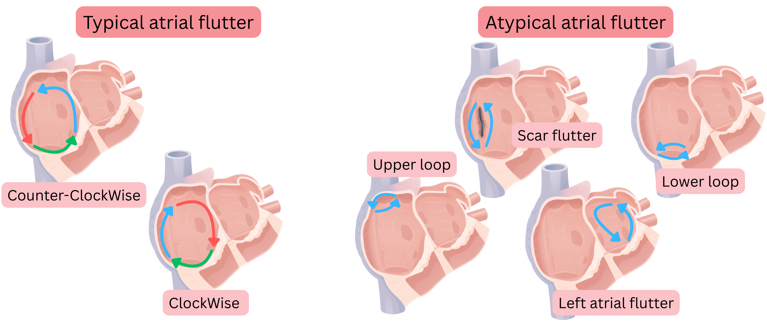 Diagram comparing typical atrial flutter with clockwise and counterclockwise reentry circuits and atypical atrial flutter including scar-related, upper loop, lower loop, and left atrial flutter.