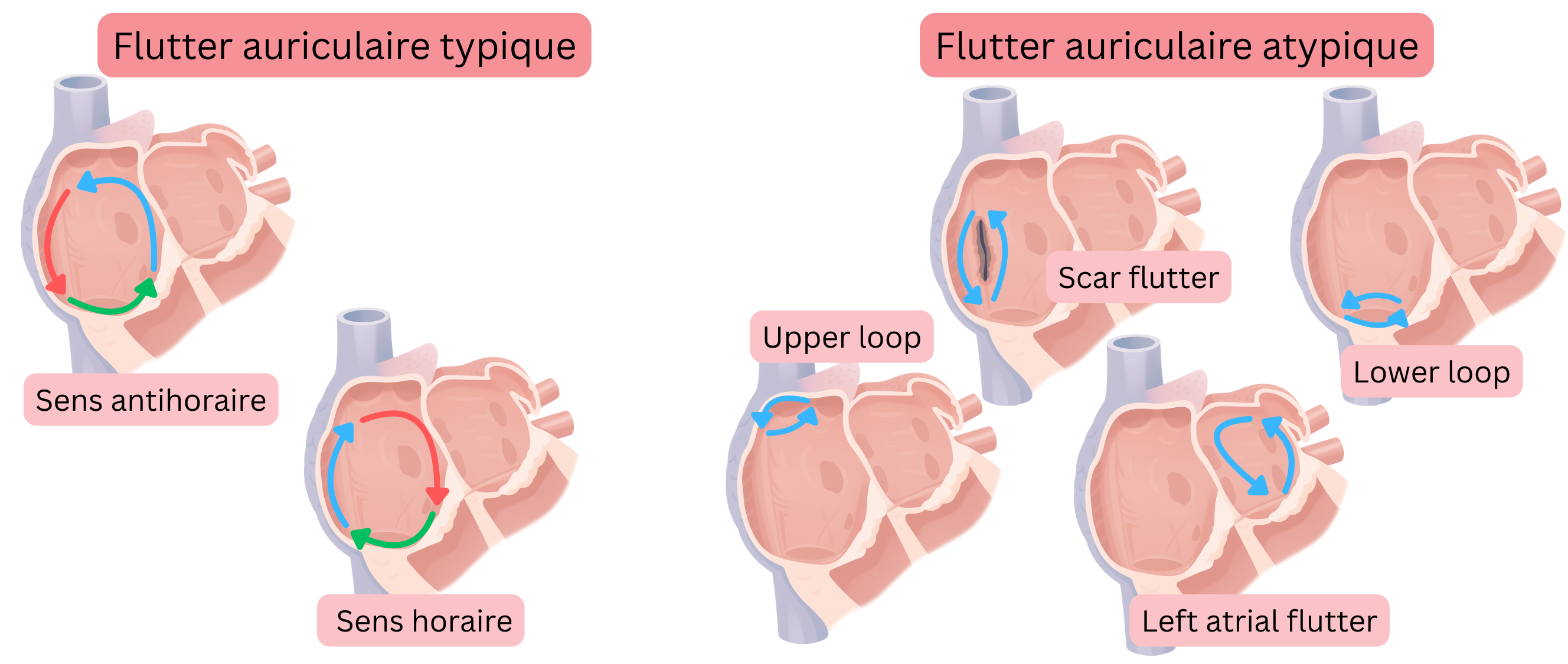 Schéma comparant le flutter auriculaire typique avec des circuits de réentrée horaire et antihoraire et le flutter auriculaire atypique, incluant les formes liées aux cicatrices, upper loop, lower loop et flutter auriculaire gauche.