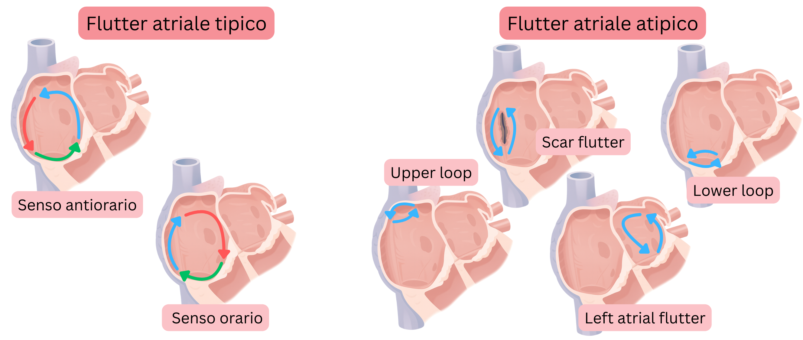Schema che confronta il flutter atriale tipico con circuiti di rientro in senso orario e antiorario e il flutter atriale atipico, includendo forme correlate a cicatrice, upper loop, lower loop e flutter atriale sinistro.