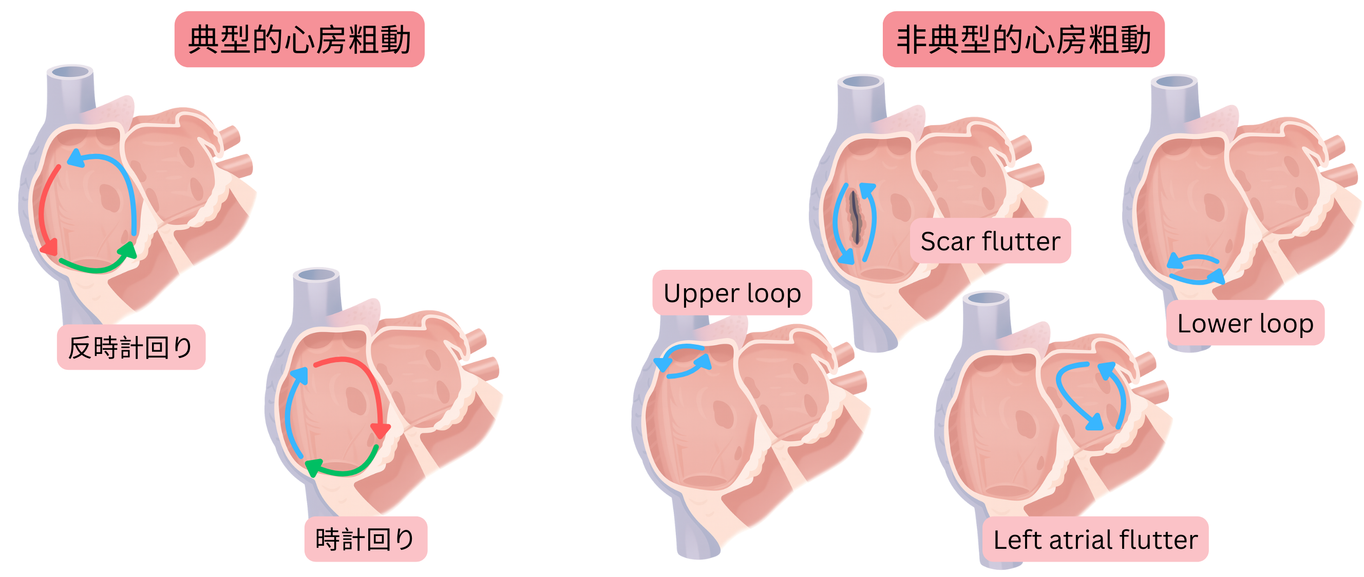 時計回りおよび反時計回りのリエントリー回路を有する典型的心房粗動と、瘢痕関連、アッパーループ、ロワーループ、左心房粗動を含む非典型的心房粗動を比較した模式図。