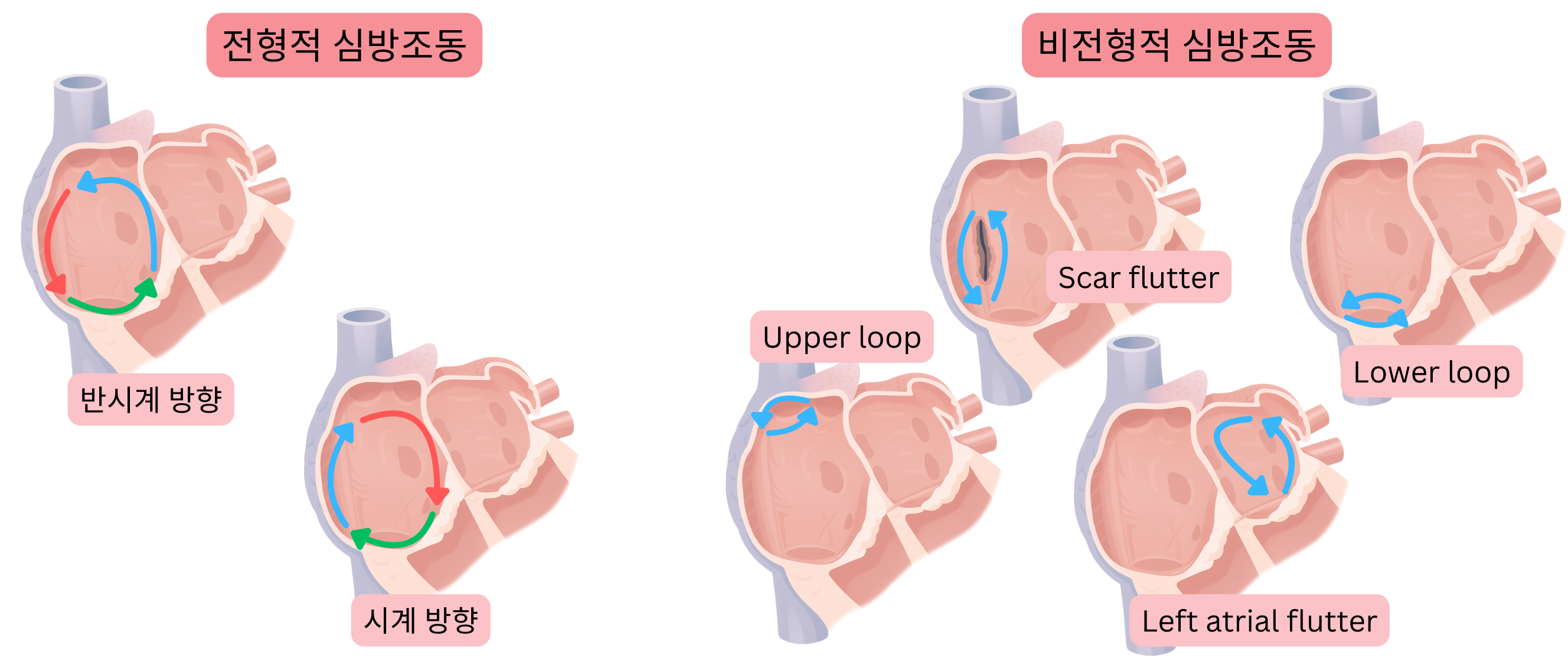 시계 방향 및 반시계 방향 재진입 회로를 갖는 전형적 심방조동과, 반흔 관련, 상부 루프, 하부 루프 및 좌심방 심방조동을 포함한 비전형적 심방조동을 비교한 도식.
