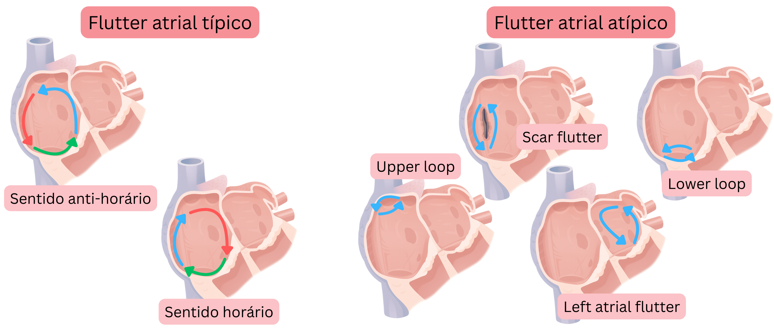 Esquema comparando o flutter atrial típico com circuitos de reentrada no sentido horário e anti-horário e o flutter atrial atípico, incluindo formas relacionadas a cicatriz, upper loop, lower loop e flutter atrial esquerdo.