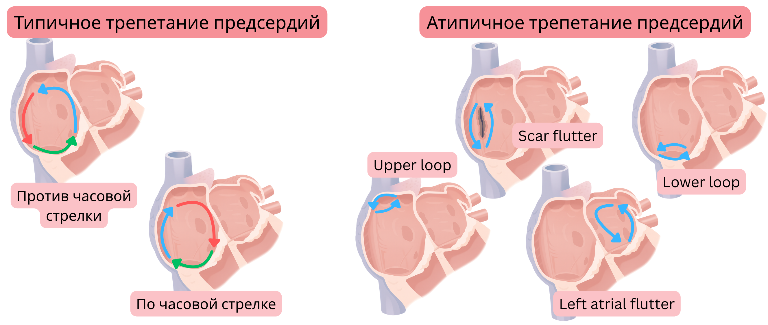 Схема сравнения типичного трепетания предсердий с риентри-контурами по и против часовой стрелки и атипичного трепетания предсердий, включая рубцово-ассоциированное, upper loop, lower loop и левопредсердное трепетание.