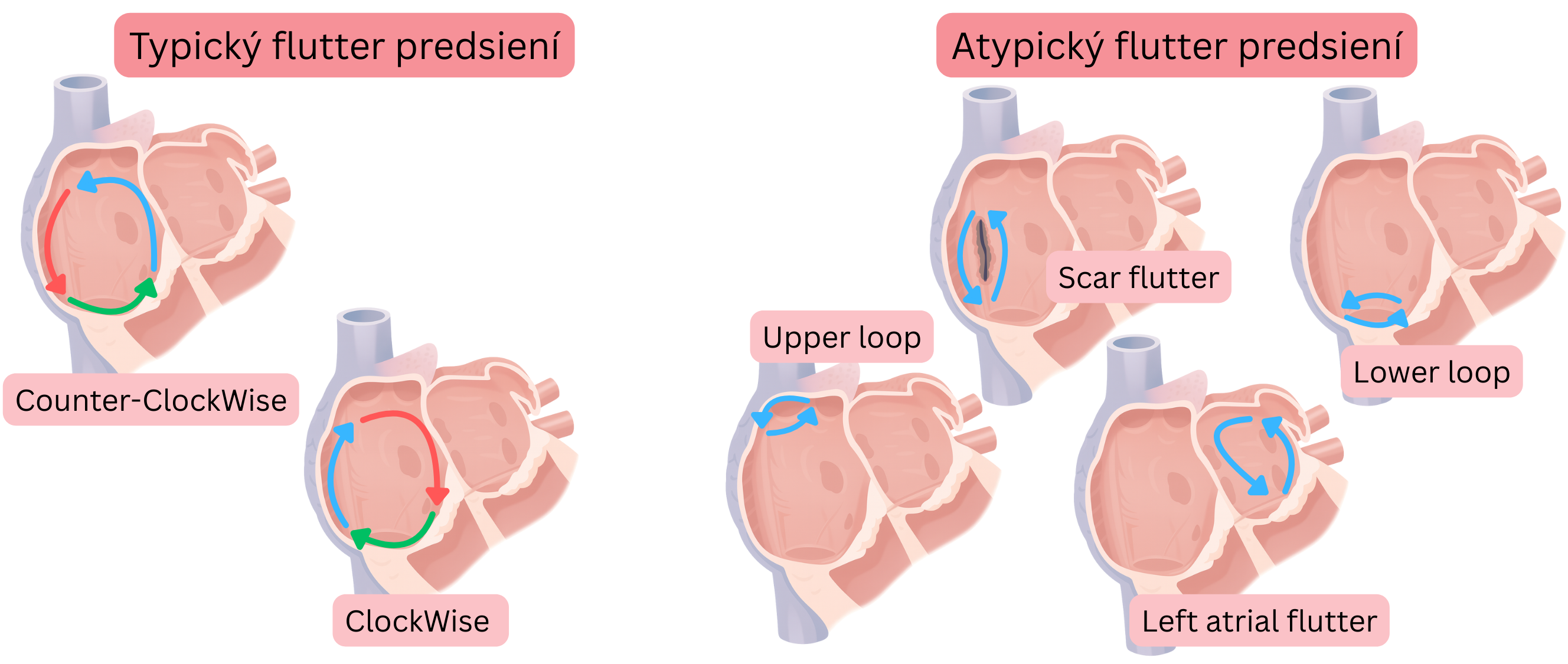 Schéma porovnávajúca typický predsieňový flutter s clockwise a counter-clockwise reentry okruhom a atypický predsieňový flutter vrátane scar, upper loop, lower loop a ľavopredsieňového flutteru.