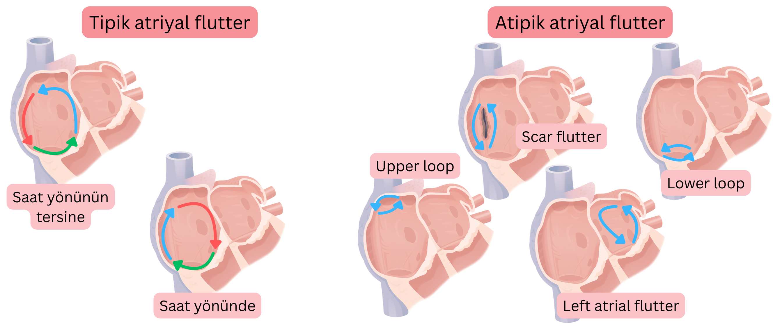Saat yönünde ve tersine reentry devreleri olan tipik atriyal flutter ile skar ilişkili, upper loop, lower loop ve sol atriyal flutter dâhil atipik atriyal flutteri karşılaştıran şema.