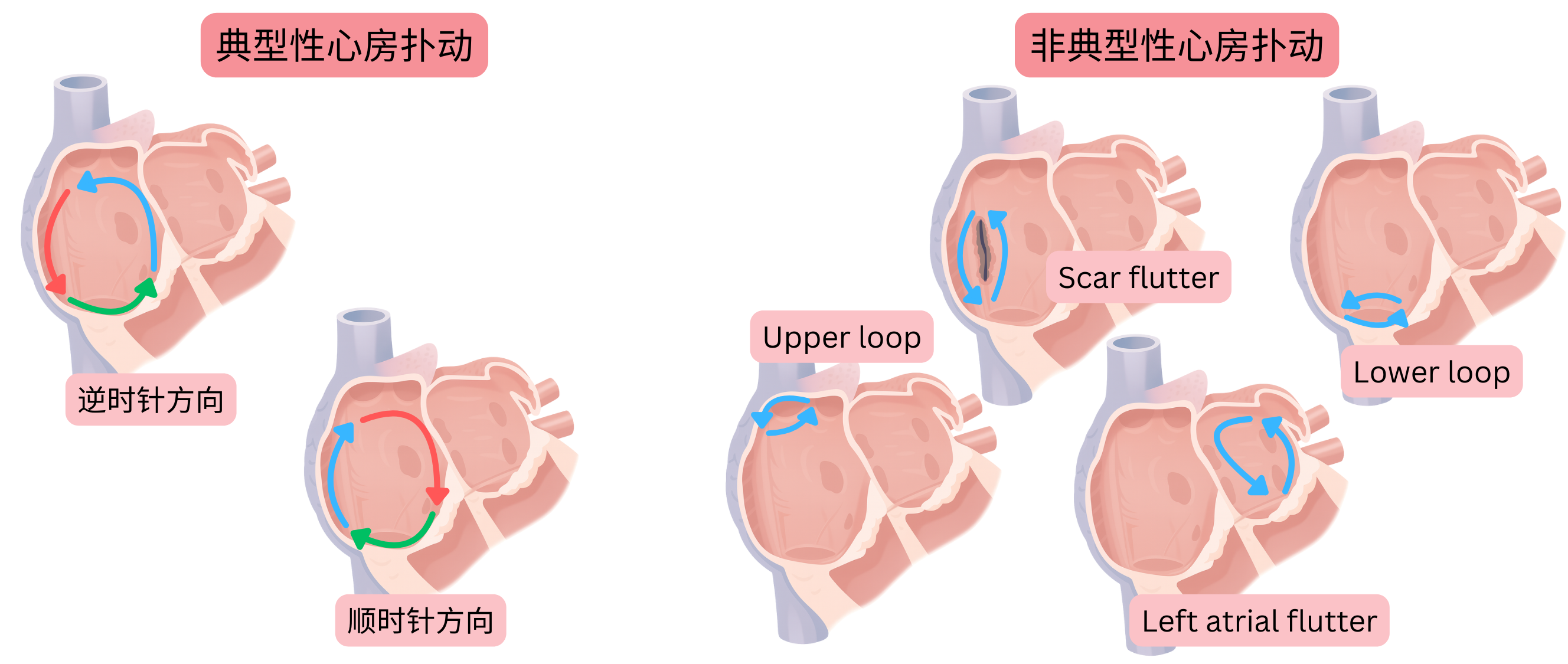 示意图比较典型心房扑动的顺时针与逆时针折返环路，以及非典型心房扑动，包括瘢痕相关、上环路、下环路和左心房扑动。