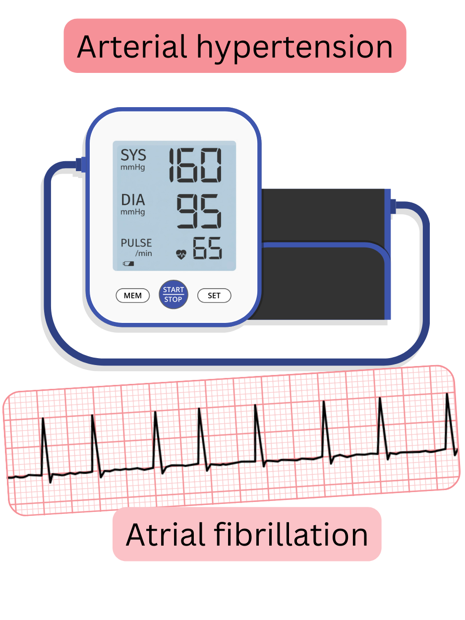 Illustration depicting the relationship between arterial hypertension and atrial fibrillation with an ECG recording of the arrhythmia.