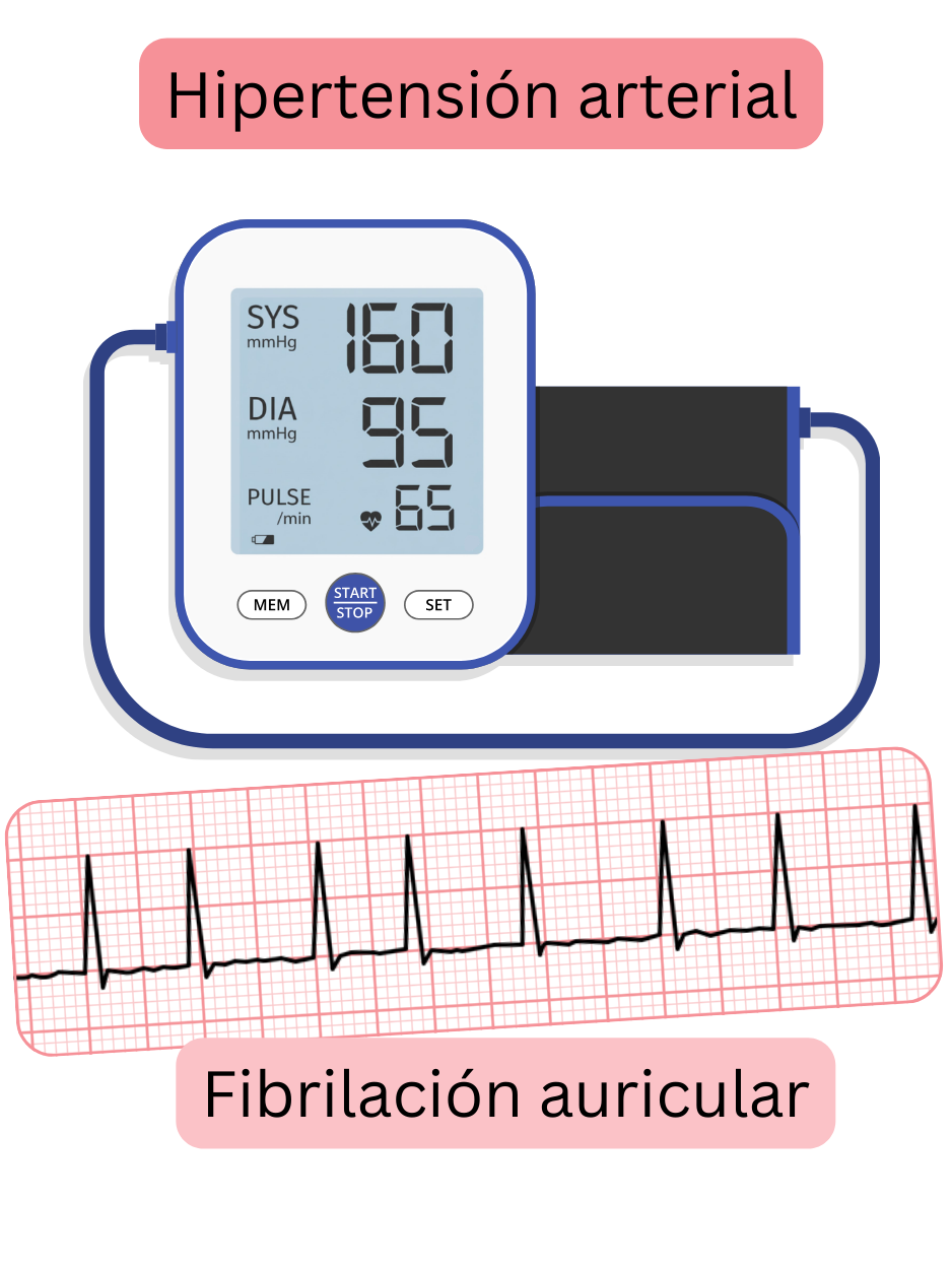 Ilustración que muestra la relación entre la hipertensión arterial y la fibrilación auricular, con un registro ECG de la arritmia.