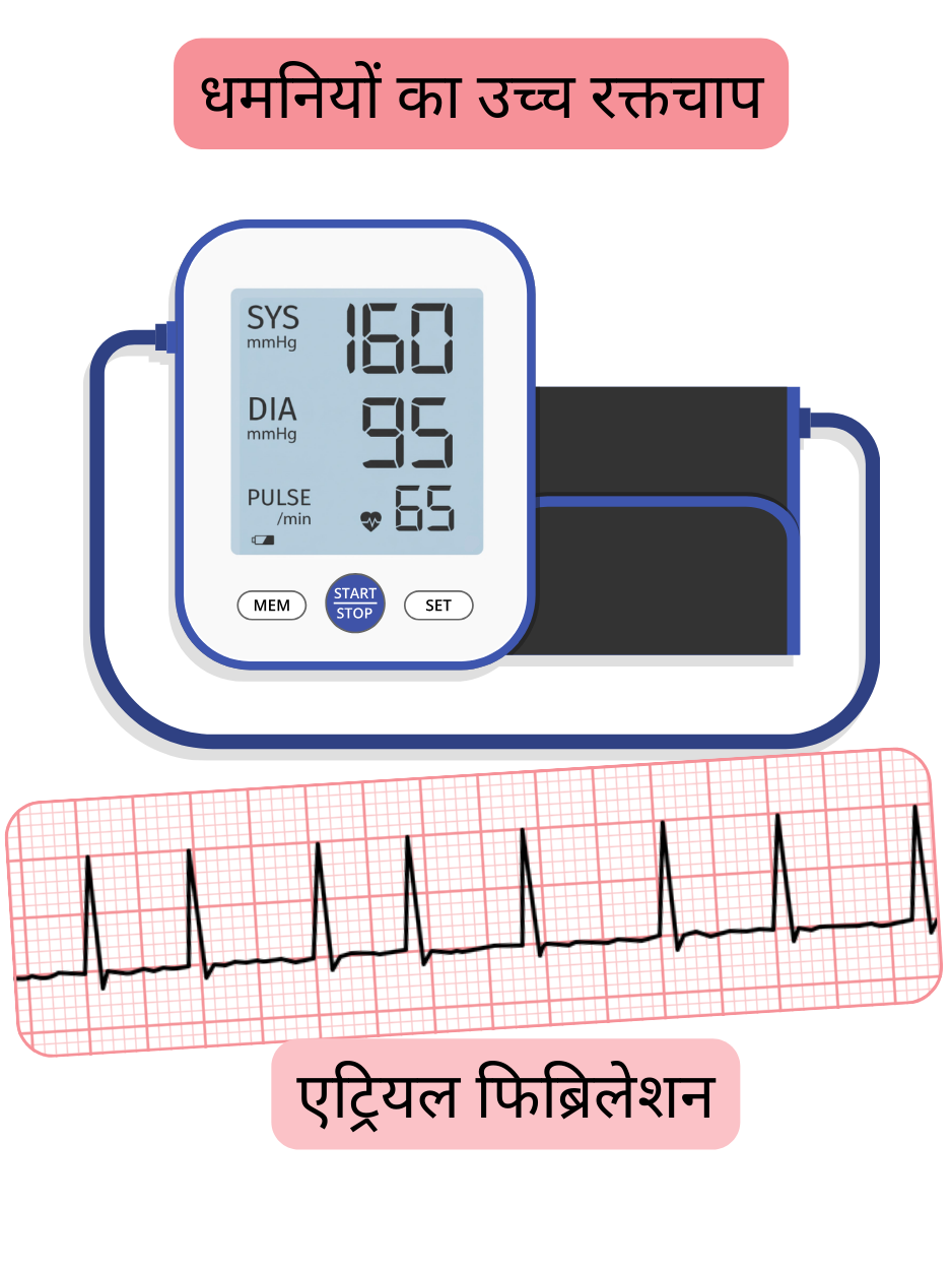 चित्रण जो धमनियों के उच्च रक्तचाप और एट्रियल फिब्रिलेशन के बीच के संबंध को दर्शाता है, साथ में अतालता का ईसीजी रिकॉर्ड भी दिखाया गया है।