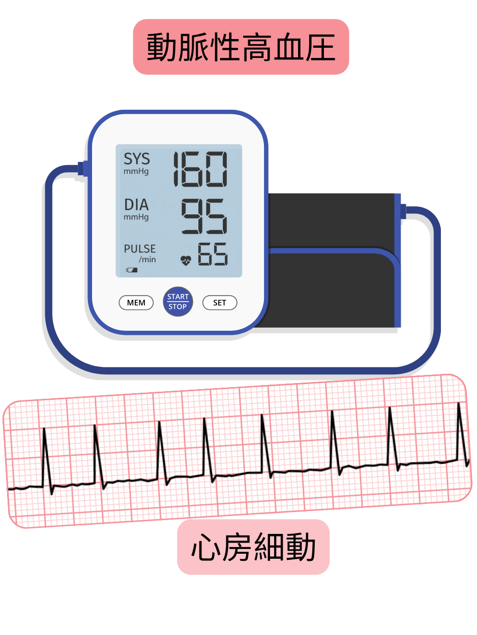 動脈性高血圧と心房細動の関連を、不整脈の心電図記録とともに示す図。