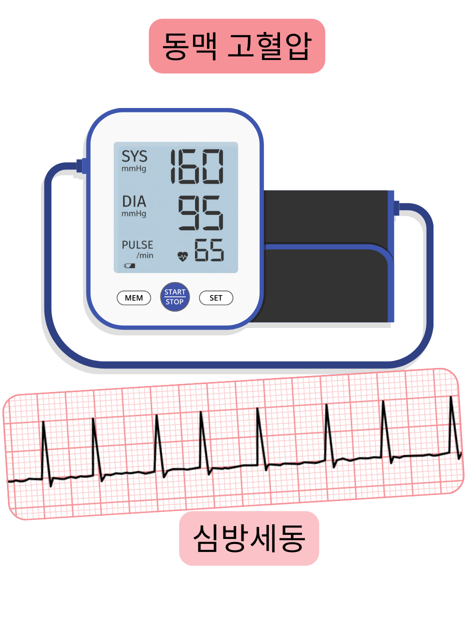 동맥 고혈압과 심방세동의 연관성을 부정맥의 심전도 기록과 함께 보여주는 그림.