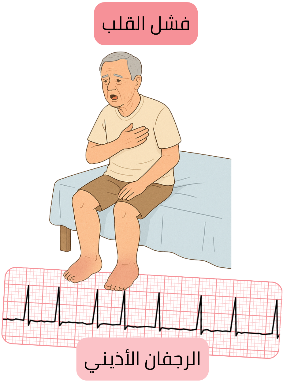 رسم توضيحي يبيّن فشل القلب كمرض مرافق مهم للرجفان الأذيني مع تسجيل تخطيط القلب لاضطراب النظم.