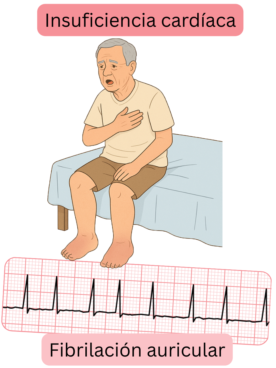 Ilustración que muestra la insuficiencia cardíaca como una comorbilidad importante de la fibrilación auricular, con un registro ECG de la arritmia.