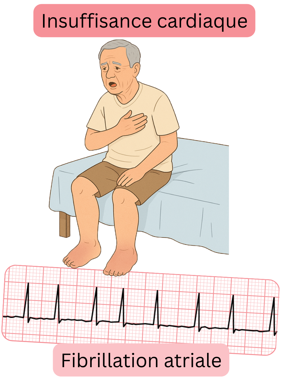 Illustration montrant l’insuffisance cardiaque comme une comorbidité majeure de la fibrillation atriale, avec un enregistrement ECG de l’arythmie.