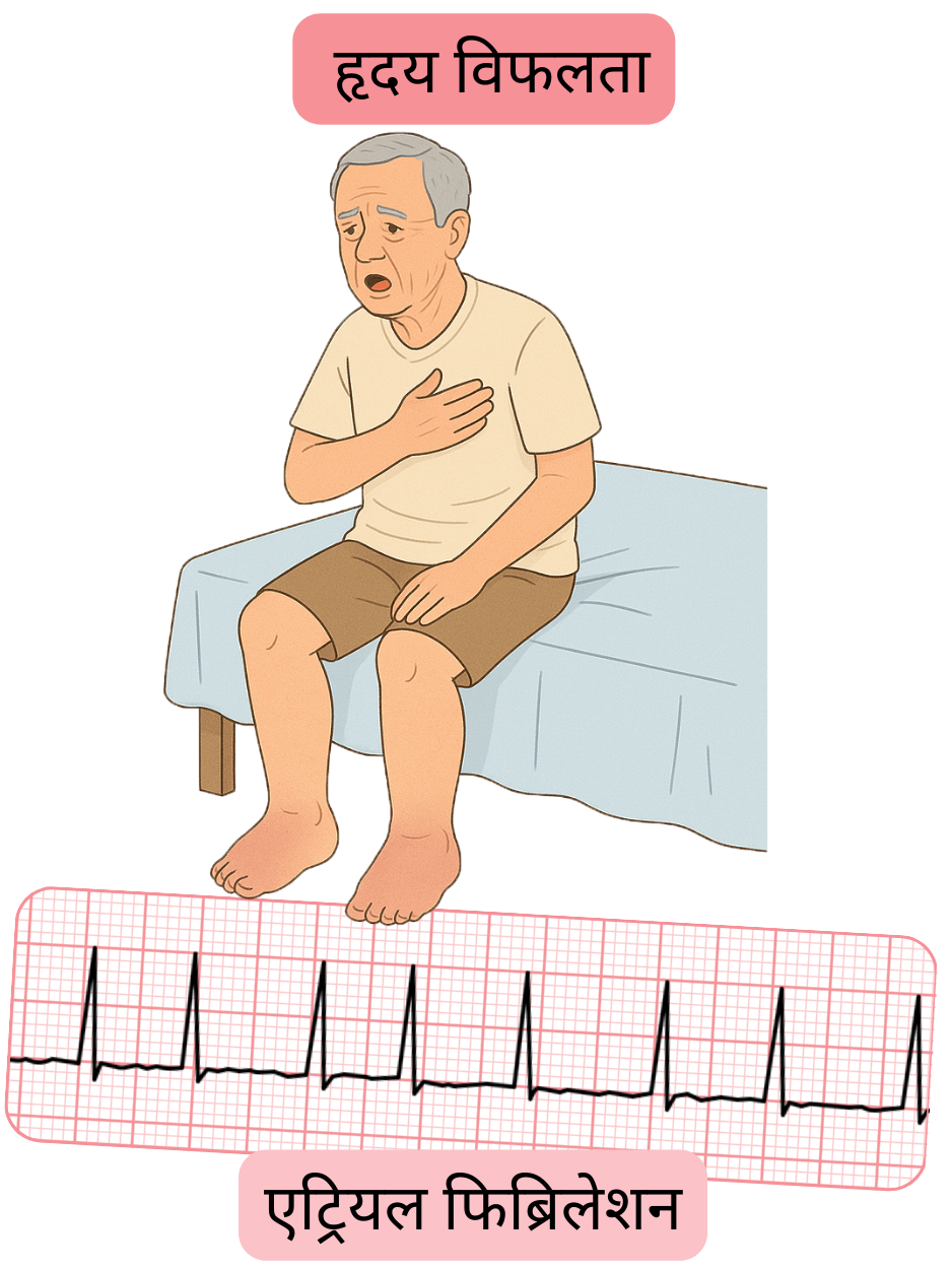 चित्रण जो हृदय विफलता को एट्रियल फिब्रिलेशन की एक महत्वपूर्ण सह-रोग स्थिति के रूप में दर्शाता है, साथ में अतालता का ईसीजी रिकॉर्ड।