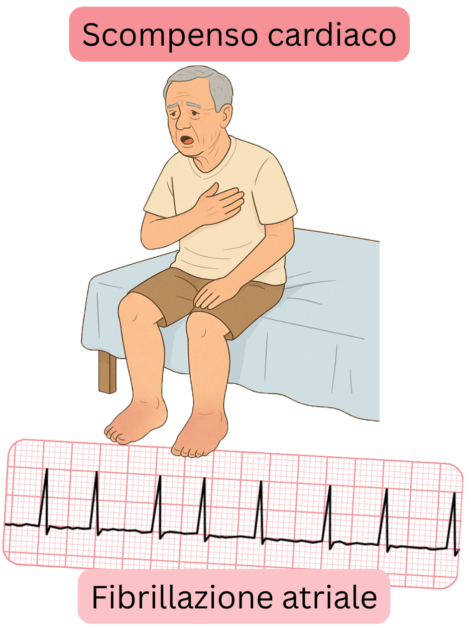 Illustrazione che raffigura lo scompenso cardiaco come una comorbidità significativa della fibrillazione atriale, con registrazione ECG dell’aritmia.